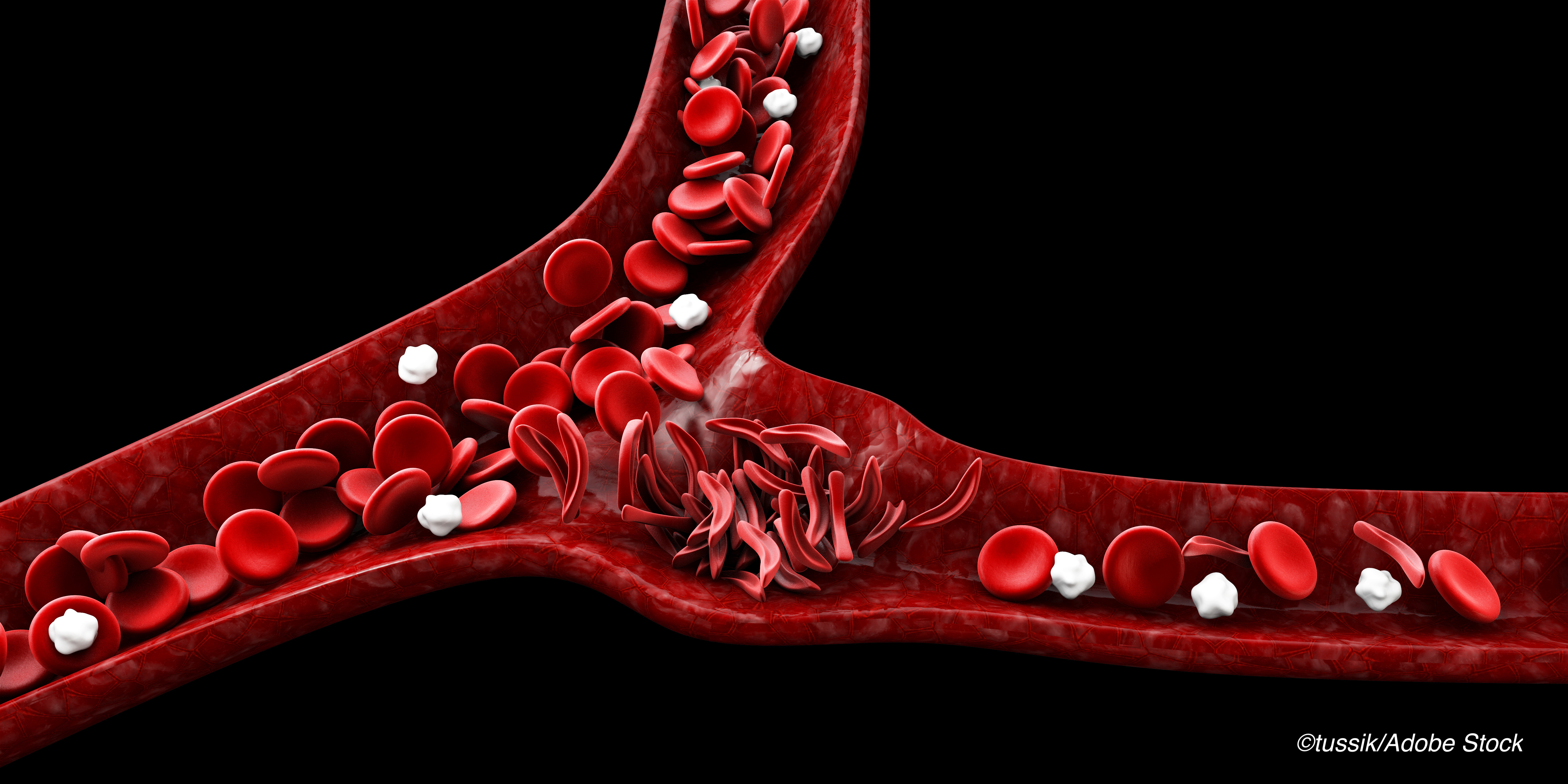 Microstructural Injury in Sickle Cell Disease May Show Stroke Vulnerability