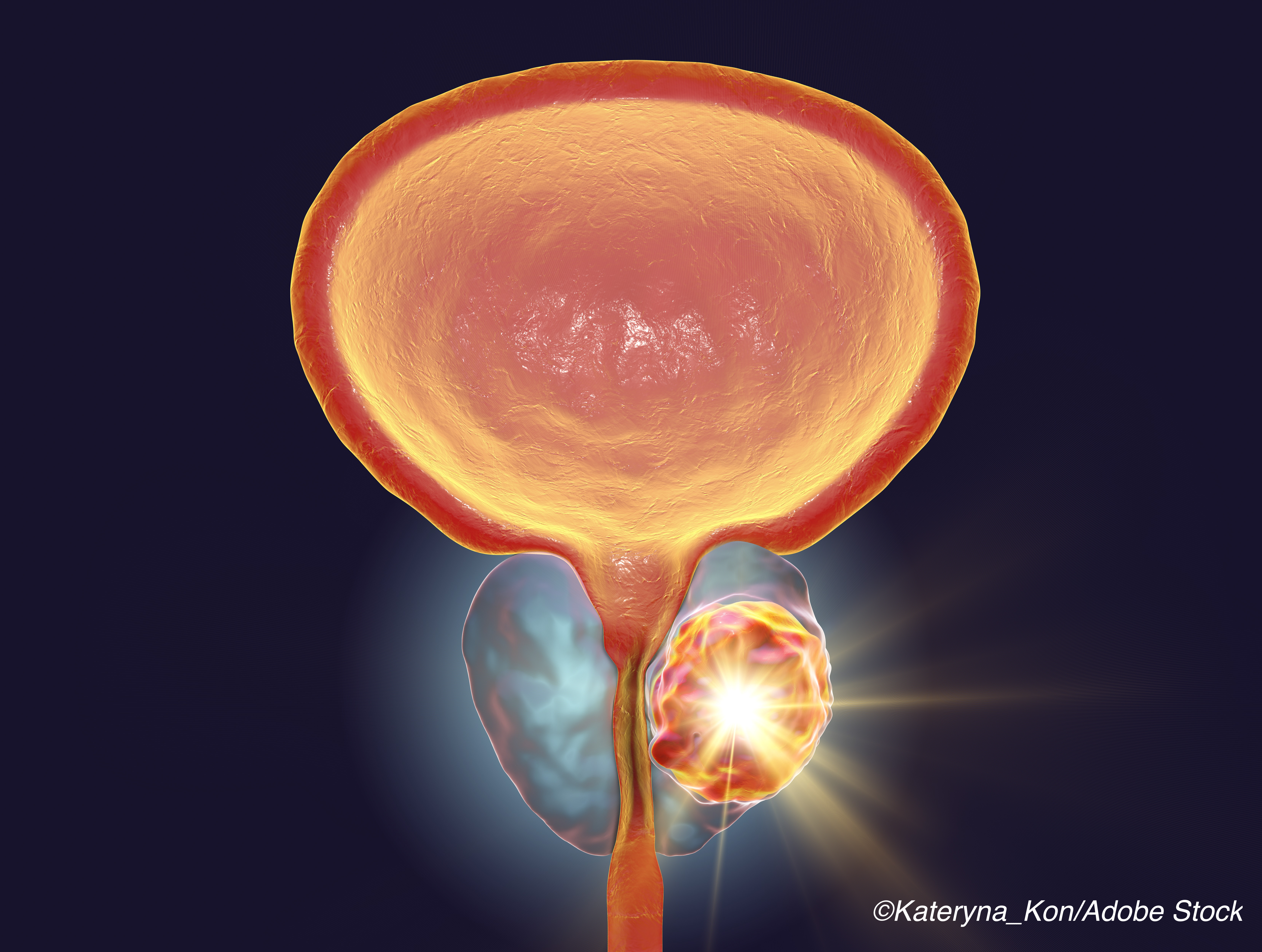 Prostate Ca: Can Standard/MRI-Targeted Biopsy Combo Cut Unnecessary Biopsies?