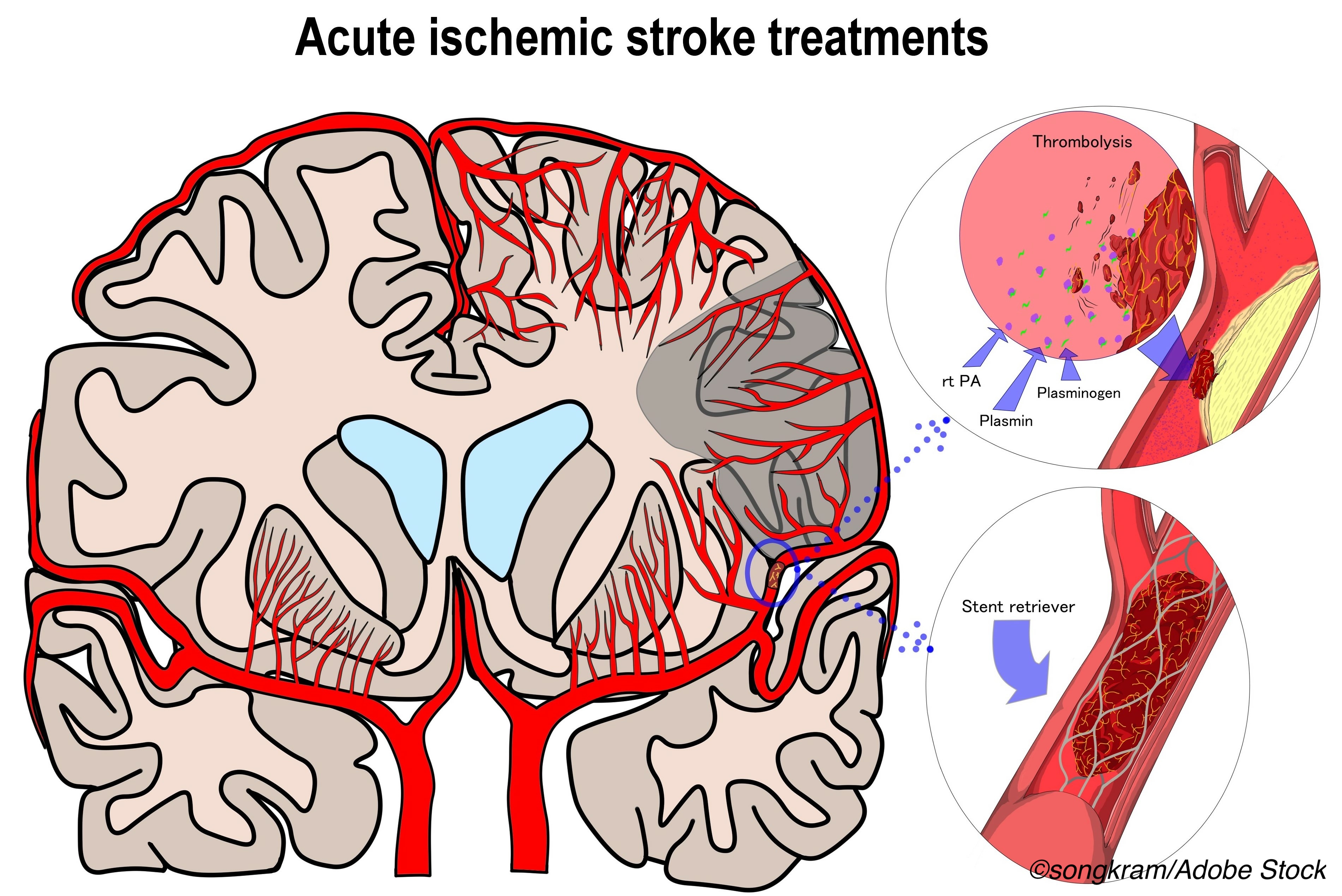Thrombectomy Benefits Seen in Stroke Patients For Up to 24 Hours