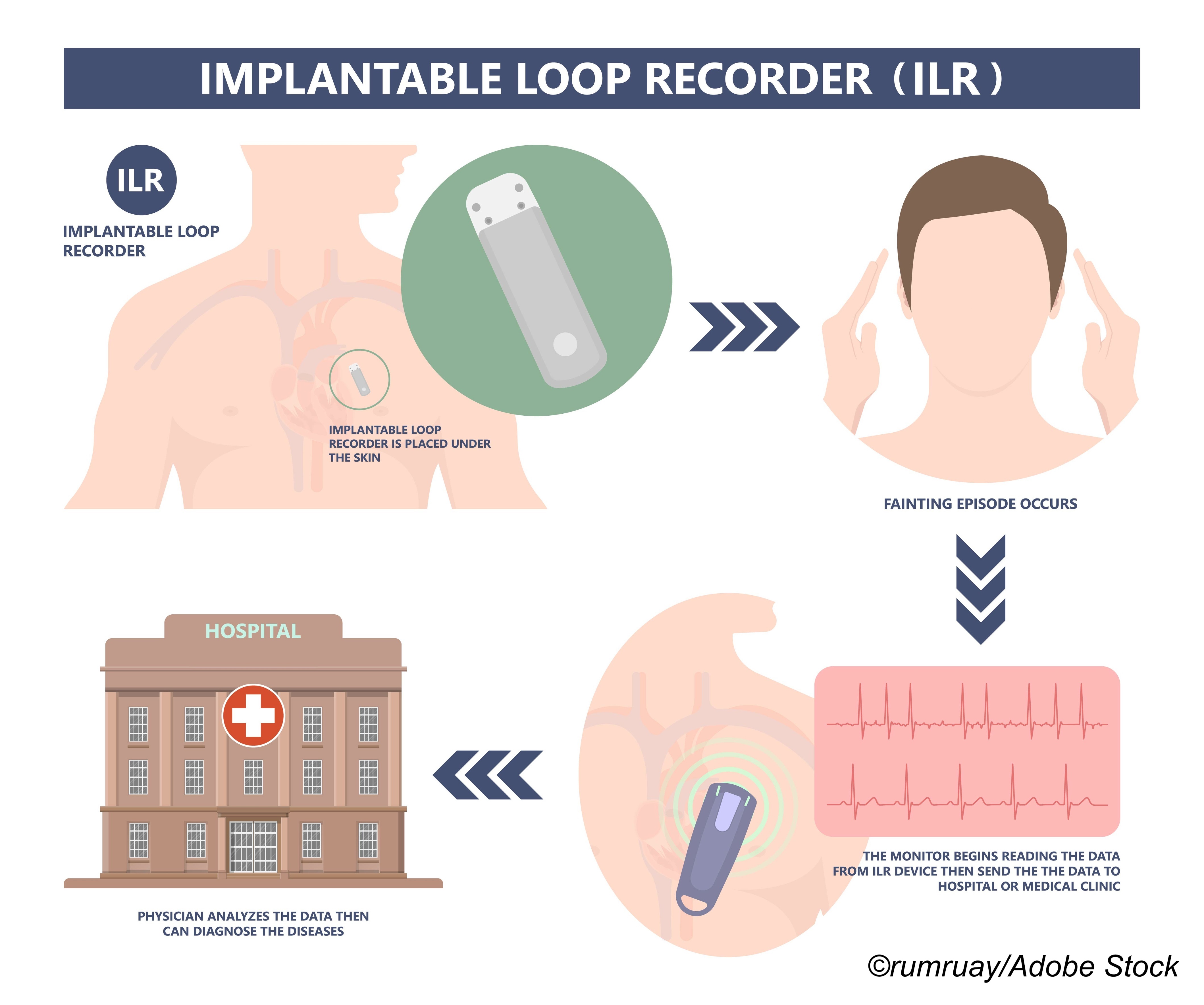 Types Of Implantable Loop Recorders At Phyllis Fetter Blog