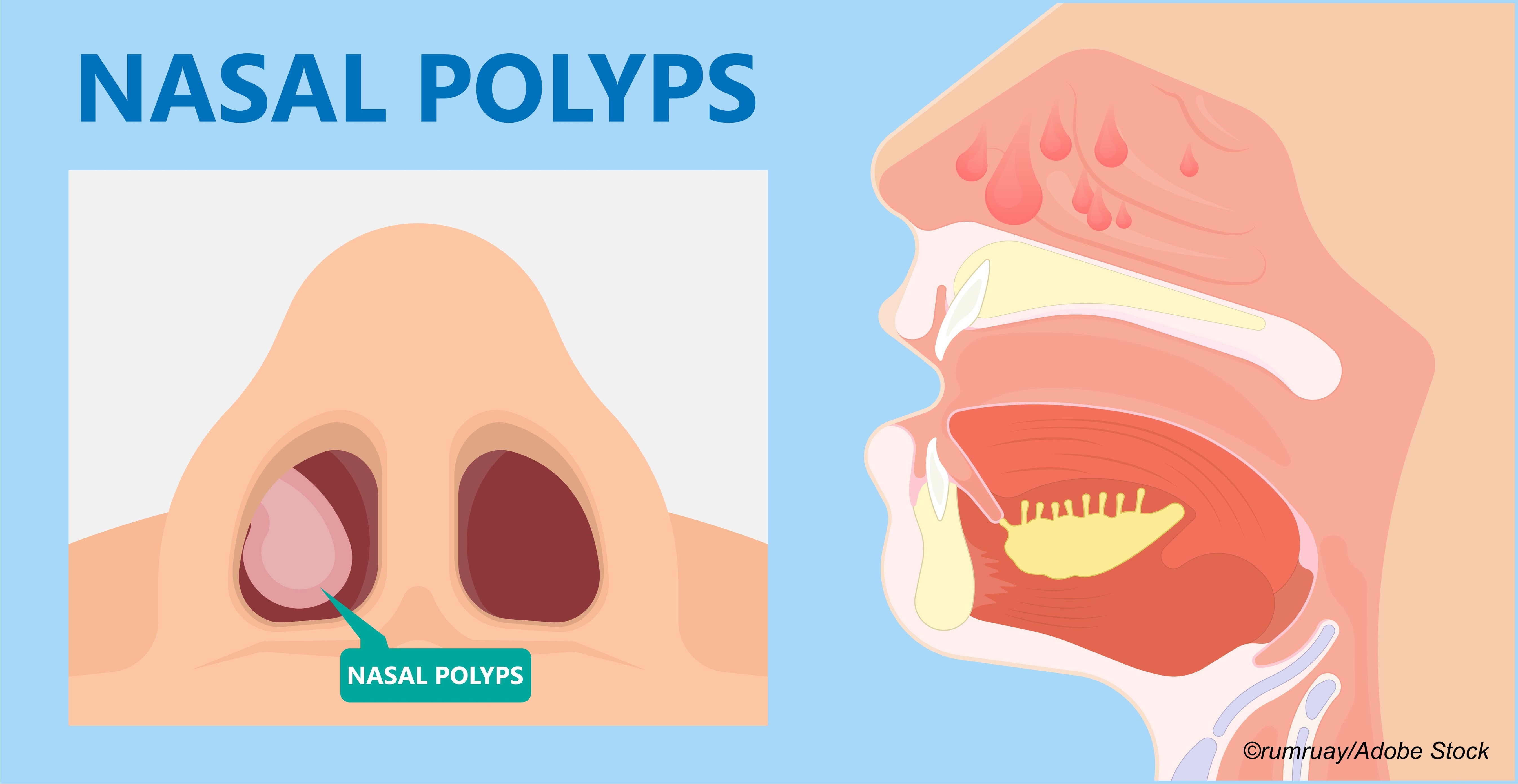 ERS: Biologic Shows Efficacy in Asthma Patients with Nasal Polyps