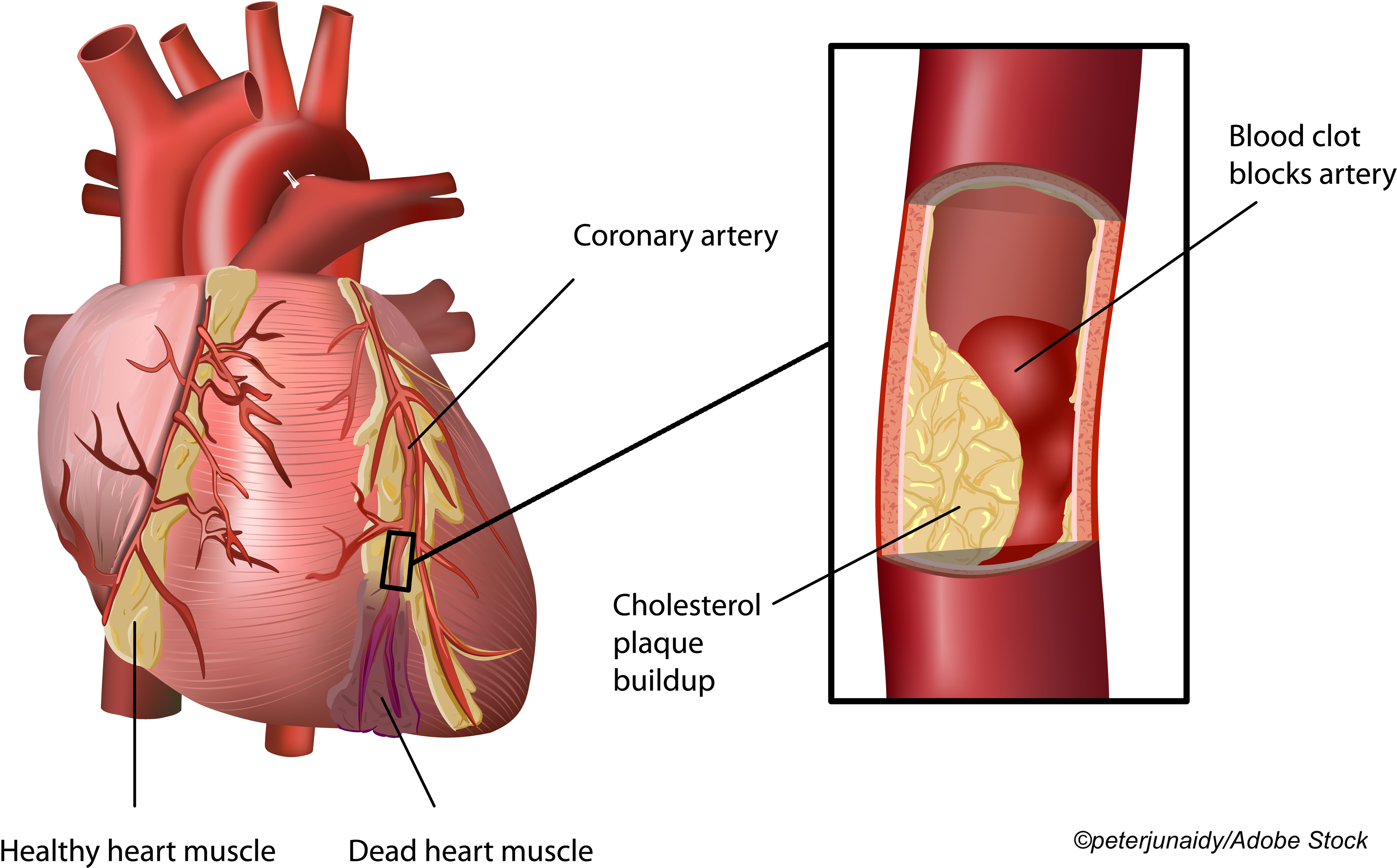 Тромбоз венечных артерий сердца
