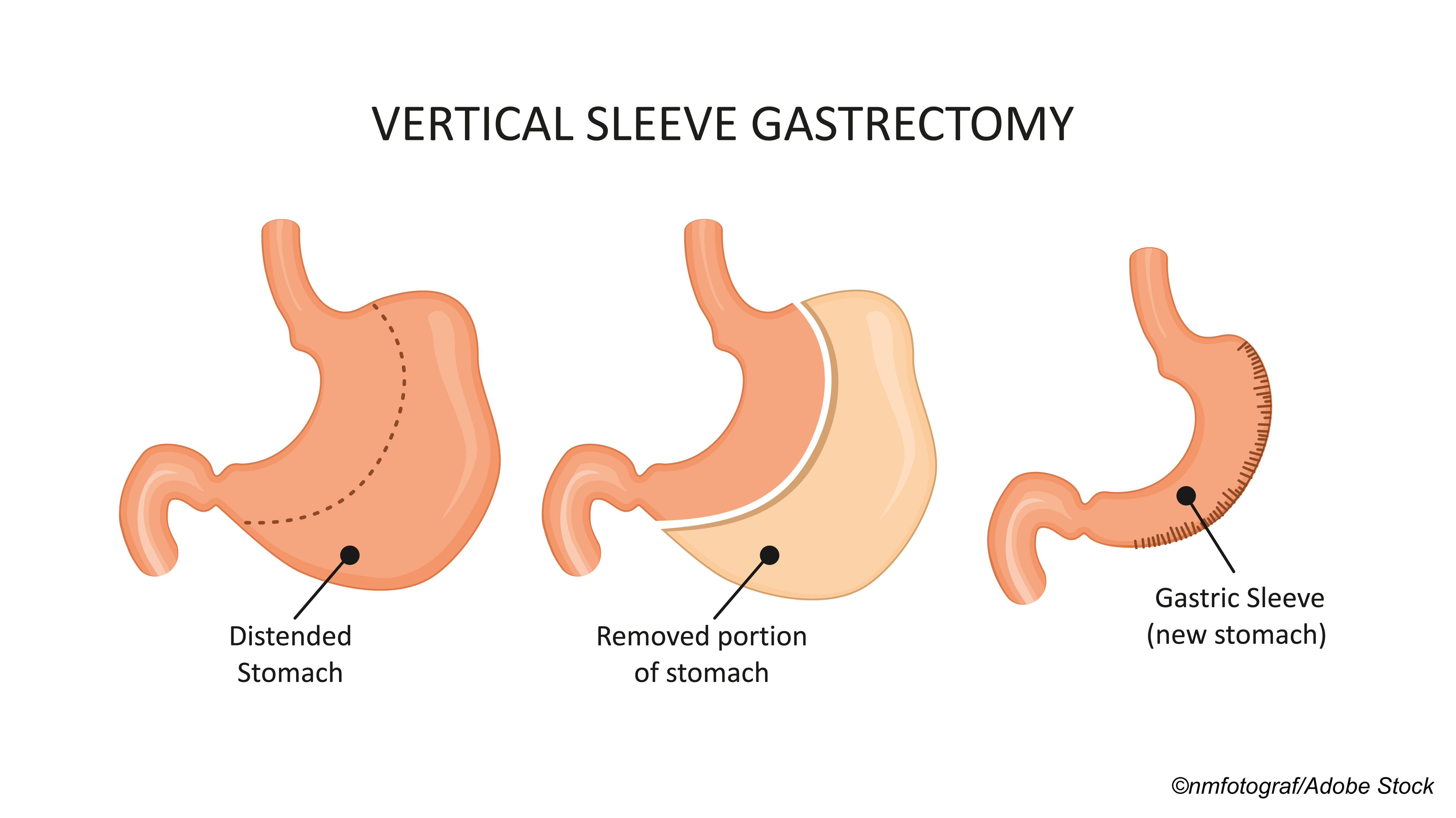 sleeve-gastrectomy-safer-than-gastric-bypass-at-5-years-but-is-it