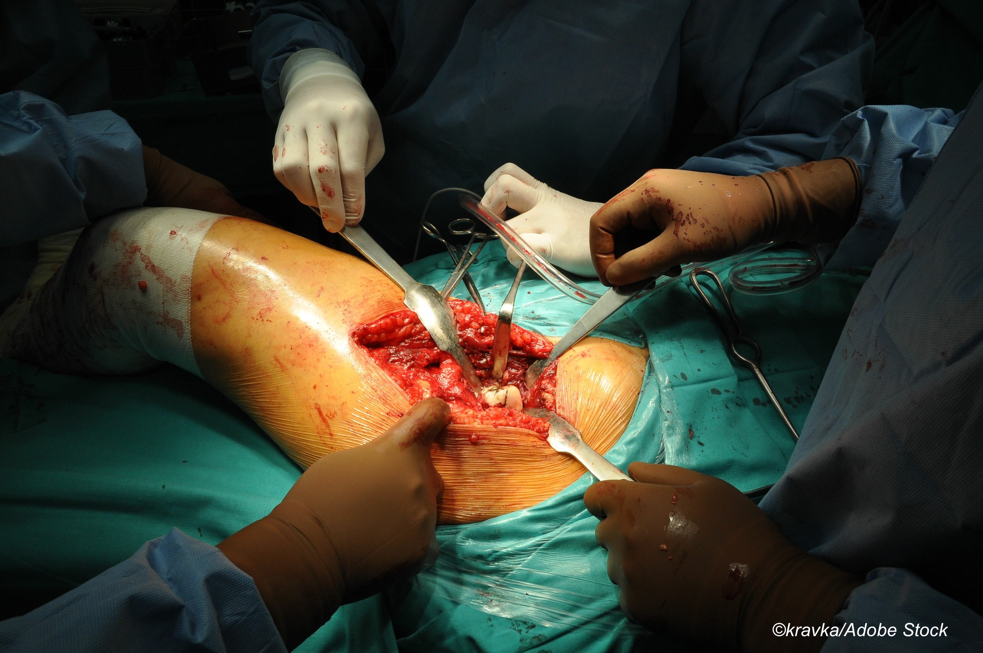 Study Finds Spinal Anesthesia Not Superior to General Anesthesia for Hip-Fracture Surgery