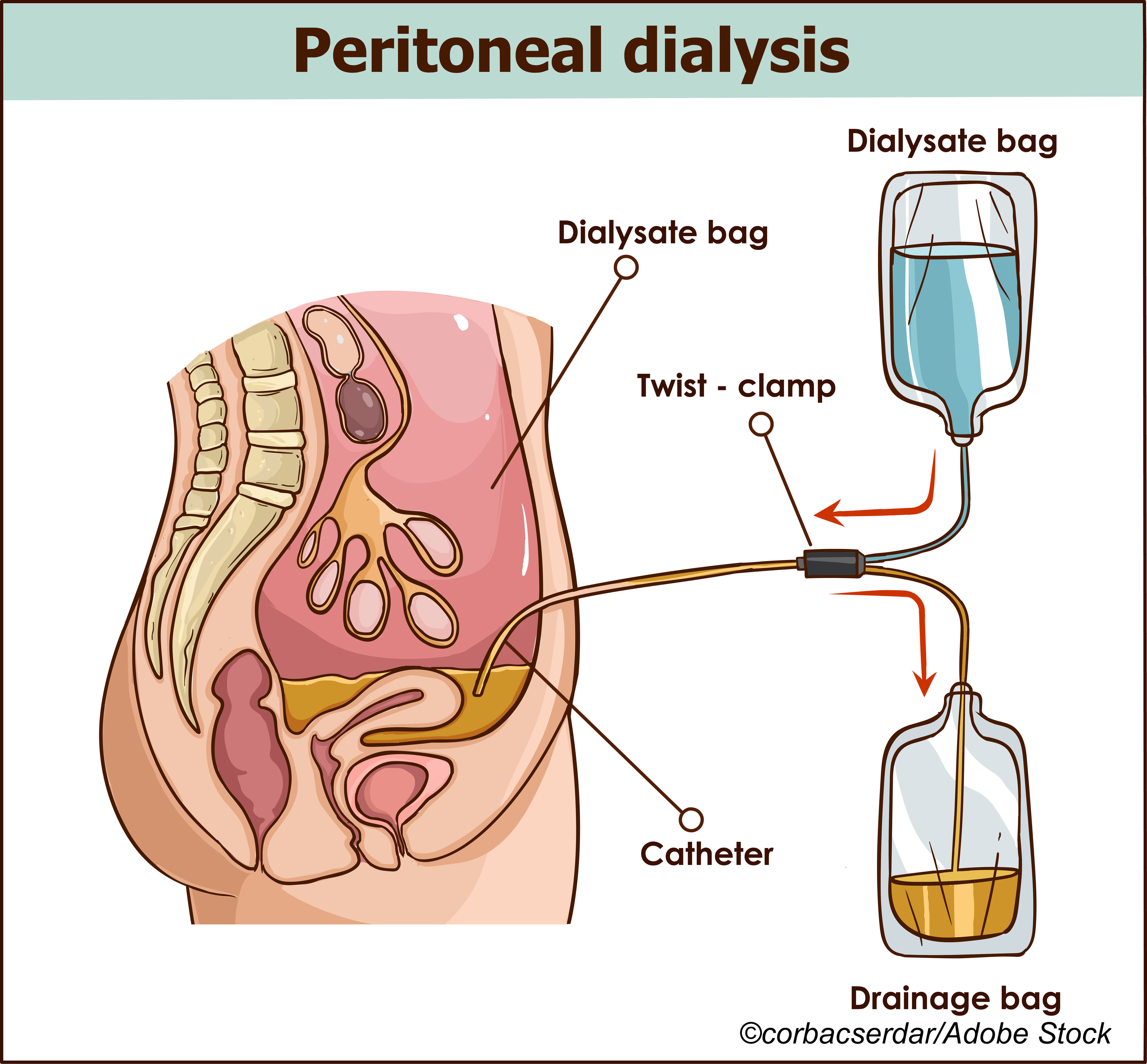 Kidney Failure: Common Gene Variant Associated with Decreased Ultrafiltration Portends Poor Outcome with Peritoneal Dialysis