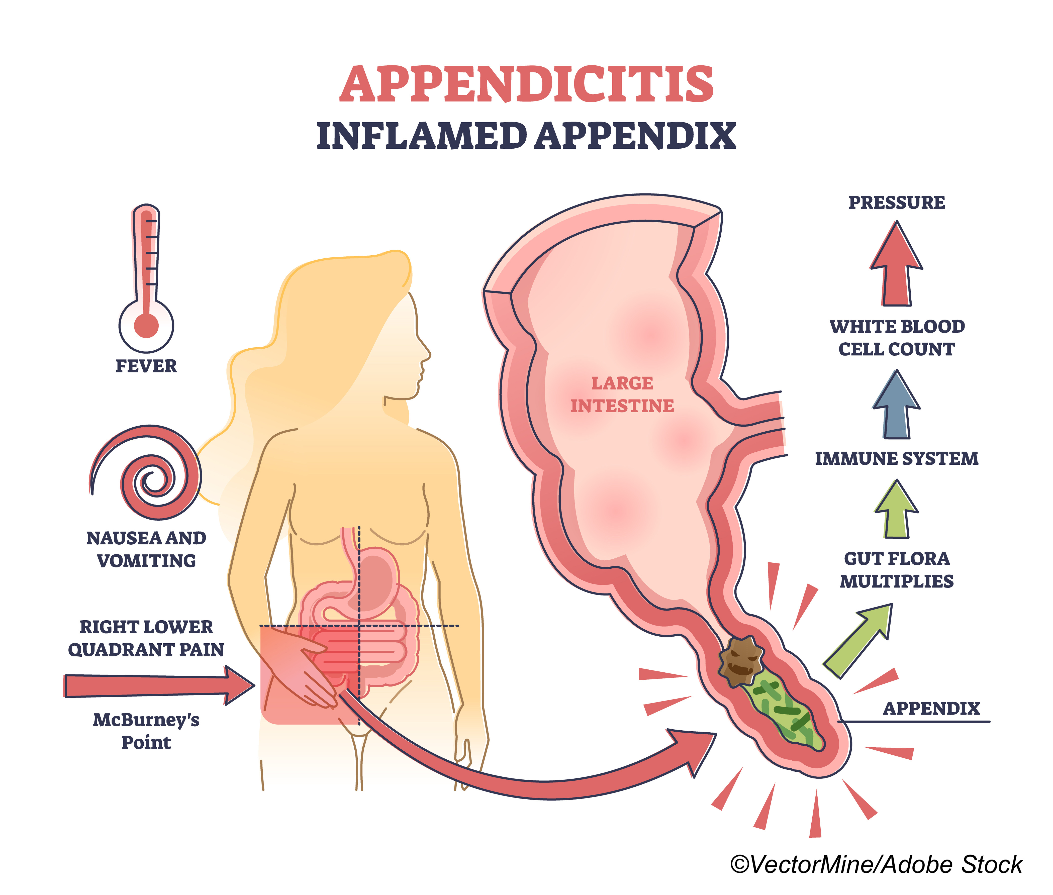 New Findings Raise Question About Durability of Antibiotic Tx for Appendicitis