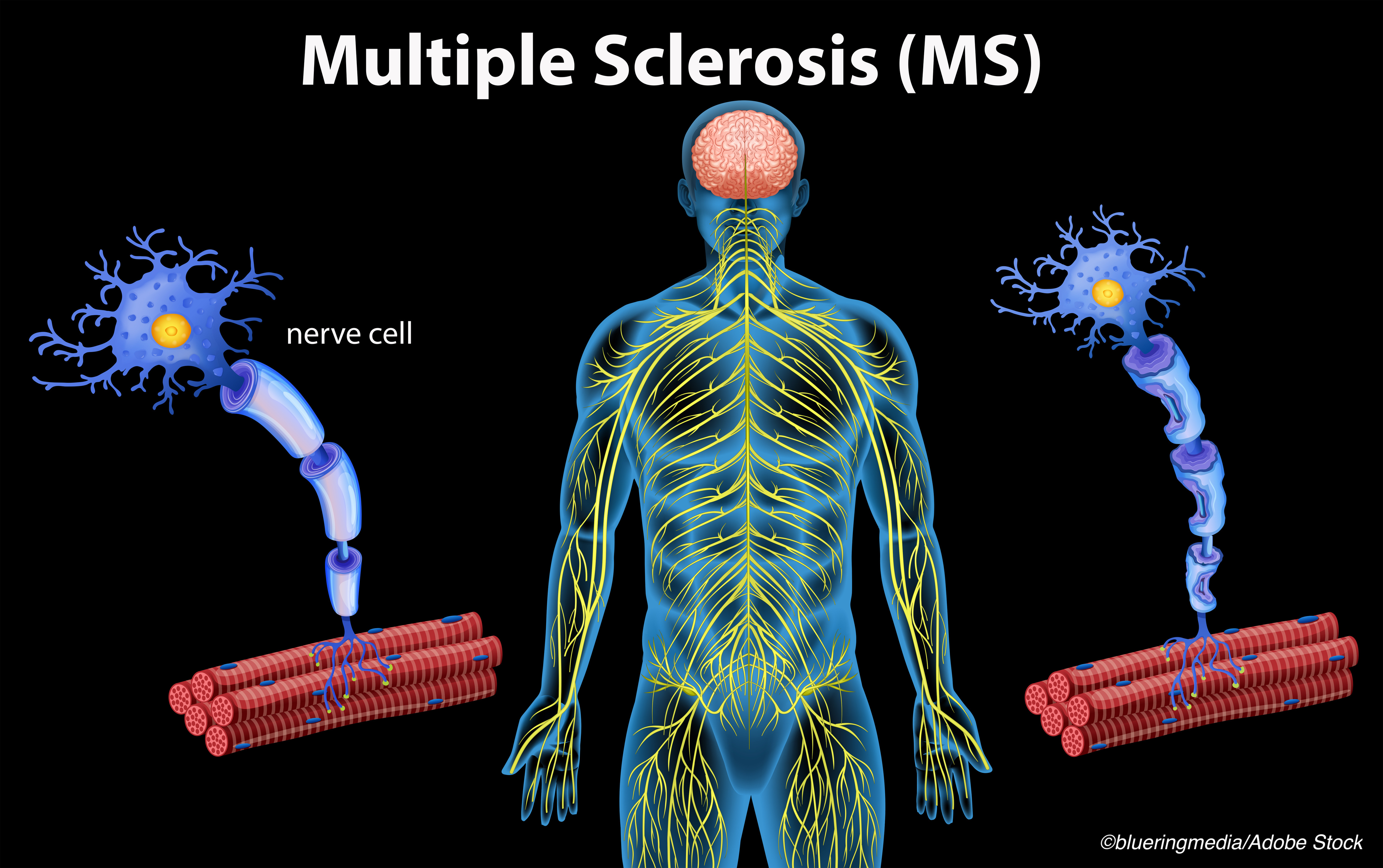 CMSC: Aggressive Versus Escalating MS Treatment Strategies