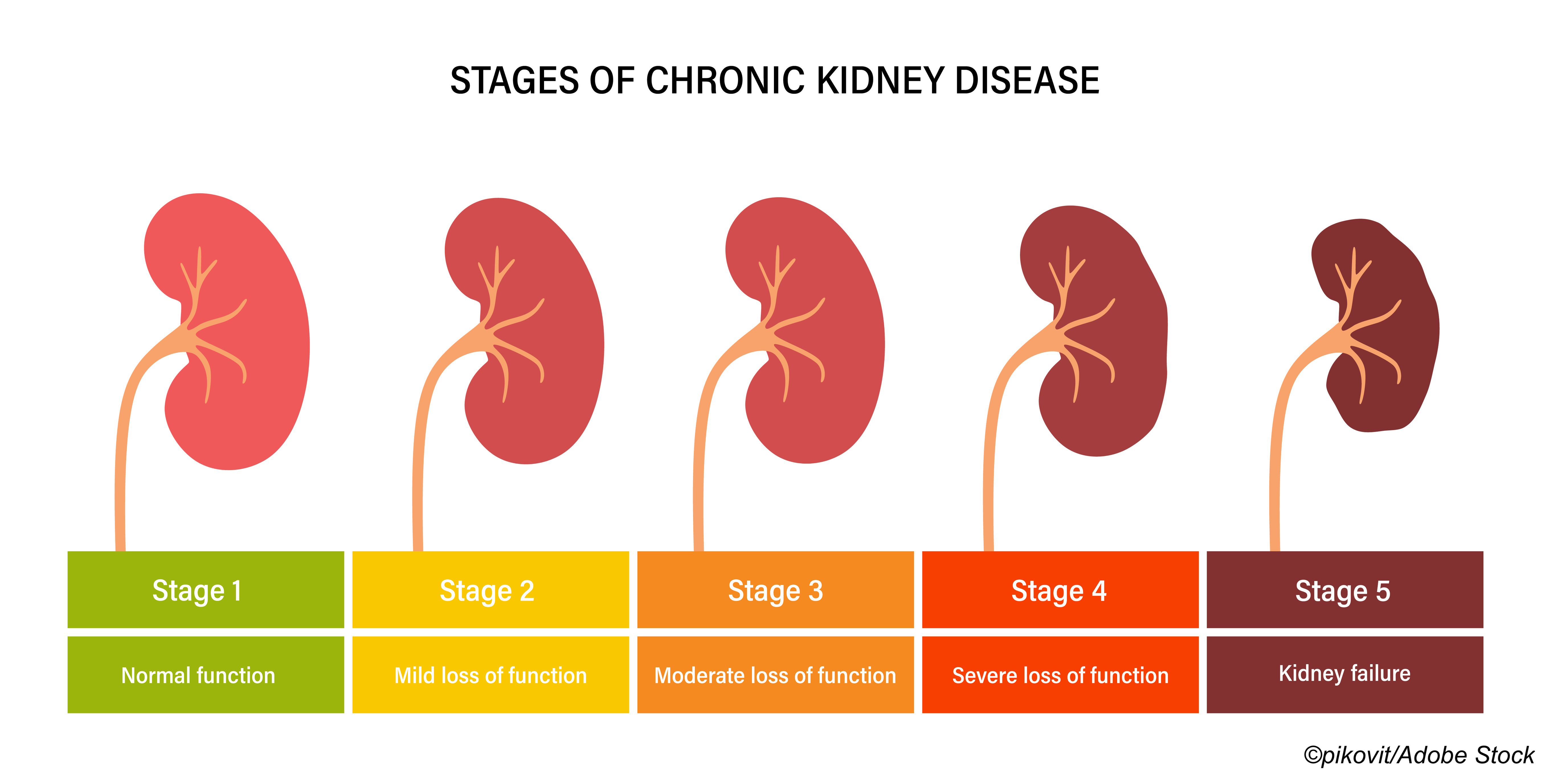 Advanced CKD And Hypertension Chlorthalidone Effective For BP Control 