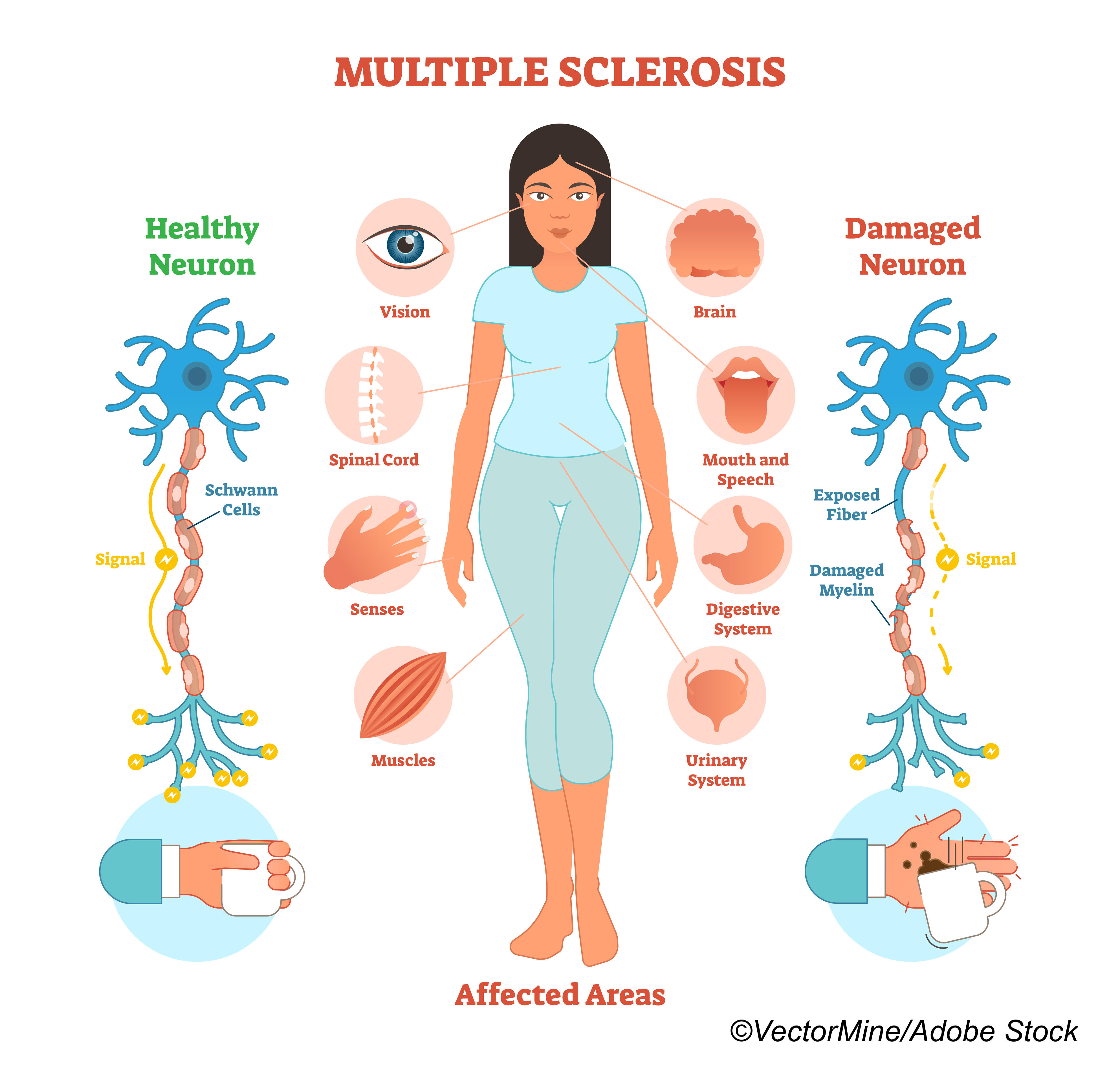 2017 Multiple Sclerosis Criteria More Sensitive But Less Specific Than 2010 Version