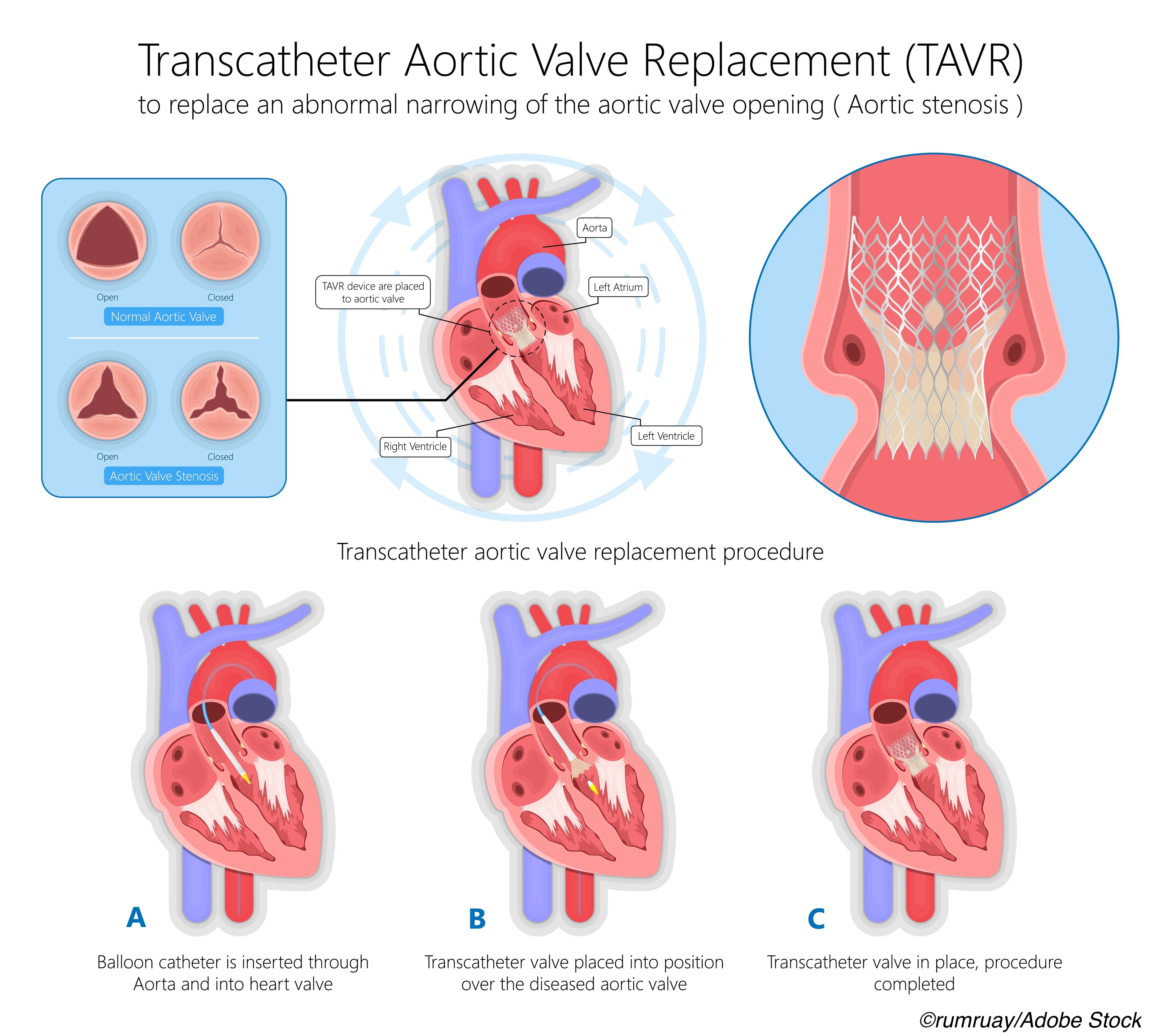 Are Race-Based Disparities Responsible for Lower TAVR Rates?
