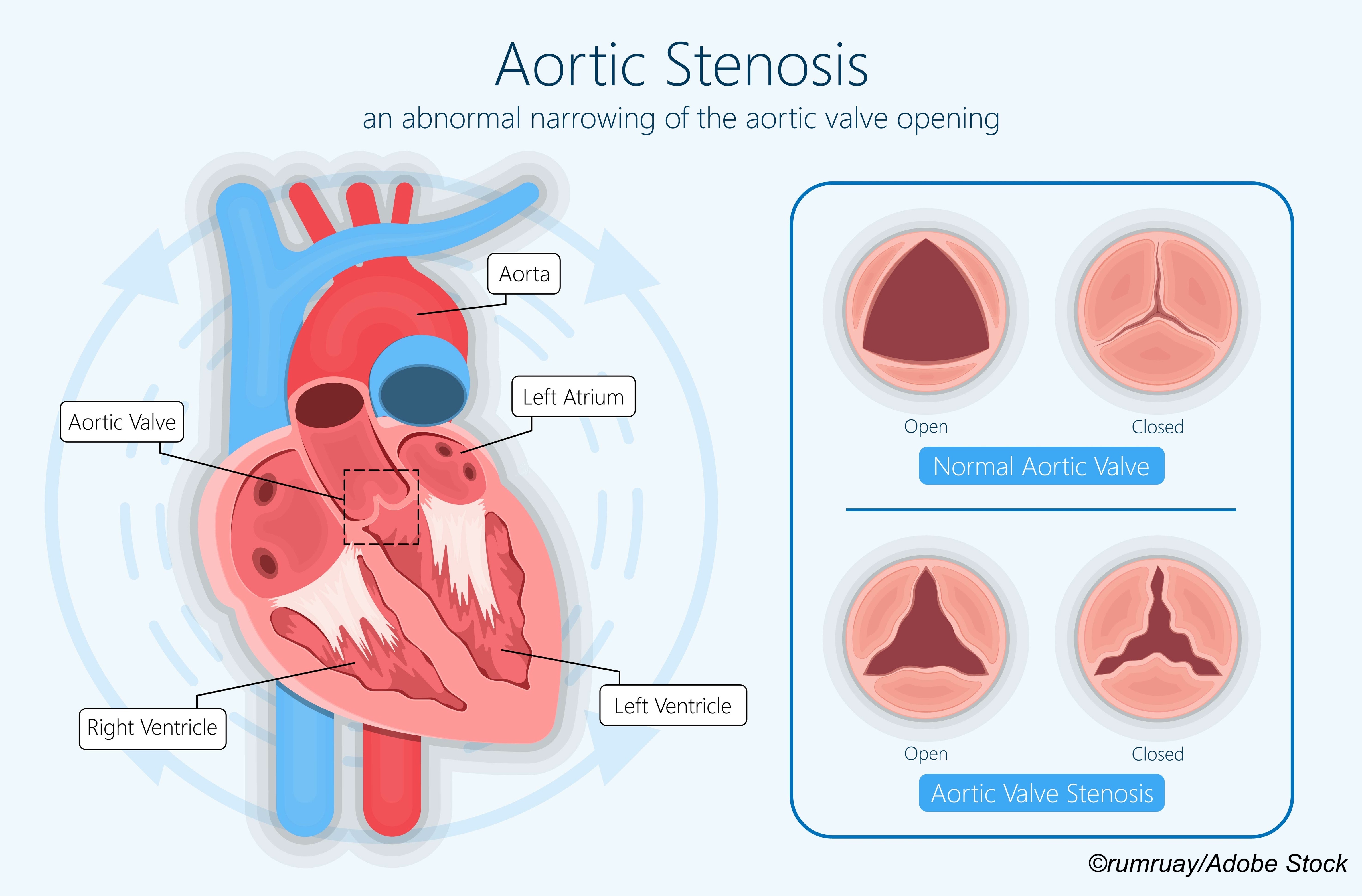 Survey Offers Snapshot of Contemporary Management of Aortic Stenosis