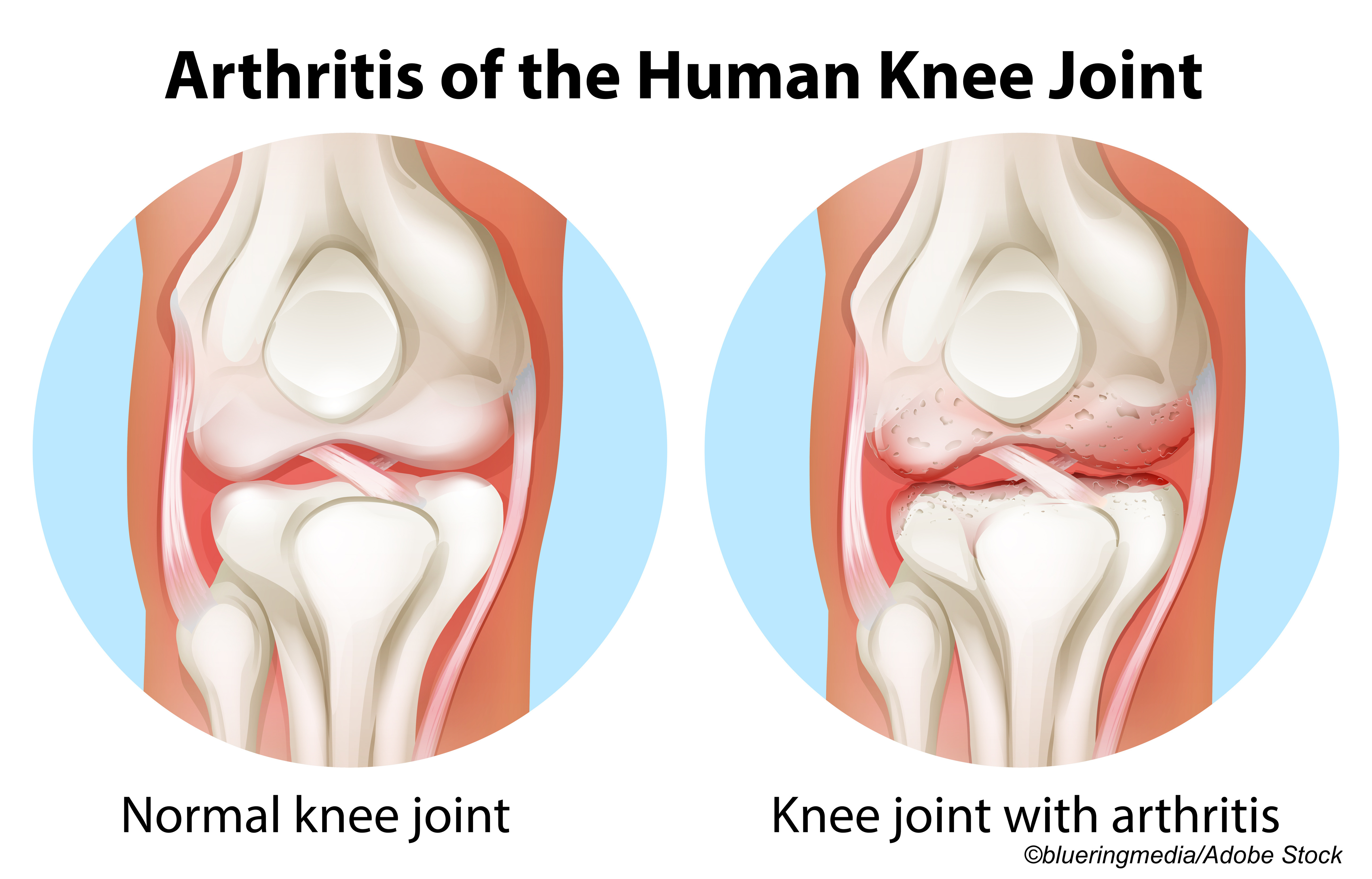 Platelet-Rich Plasma a Bust in Placebo-Controlled Trial for Knee OA
