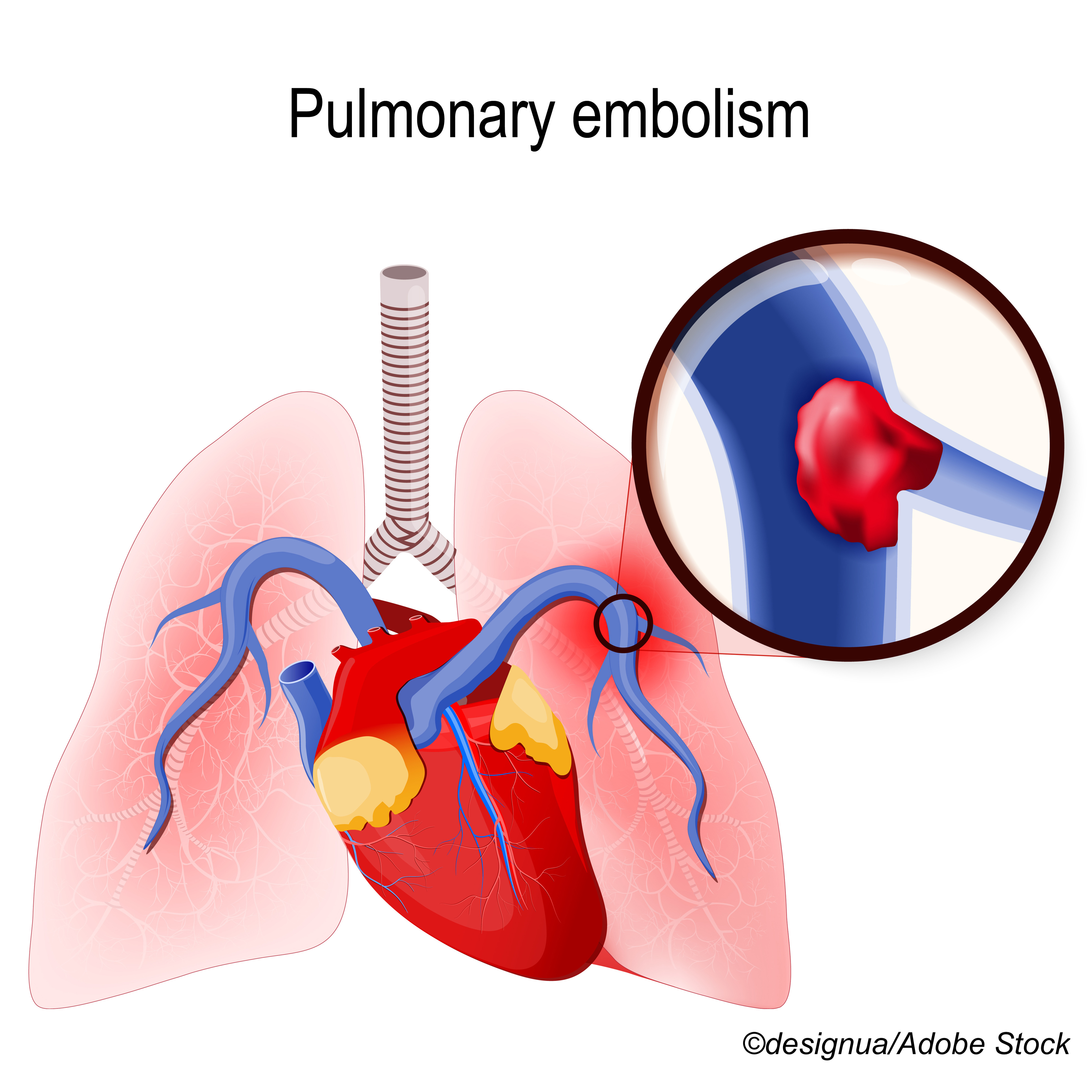 Patients With Subsegmental Pulmonary Embolism Face Increased VTE Risk