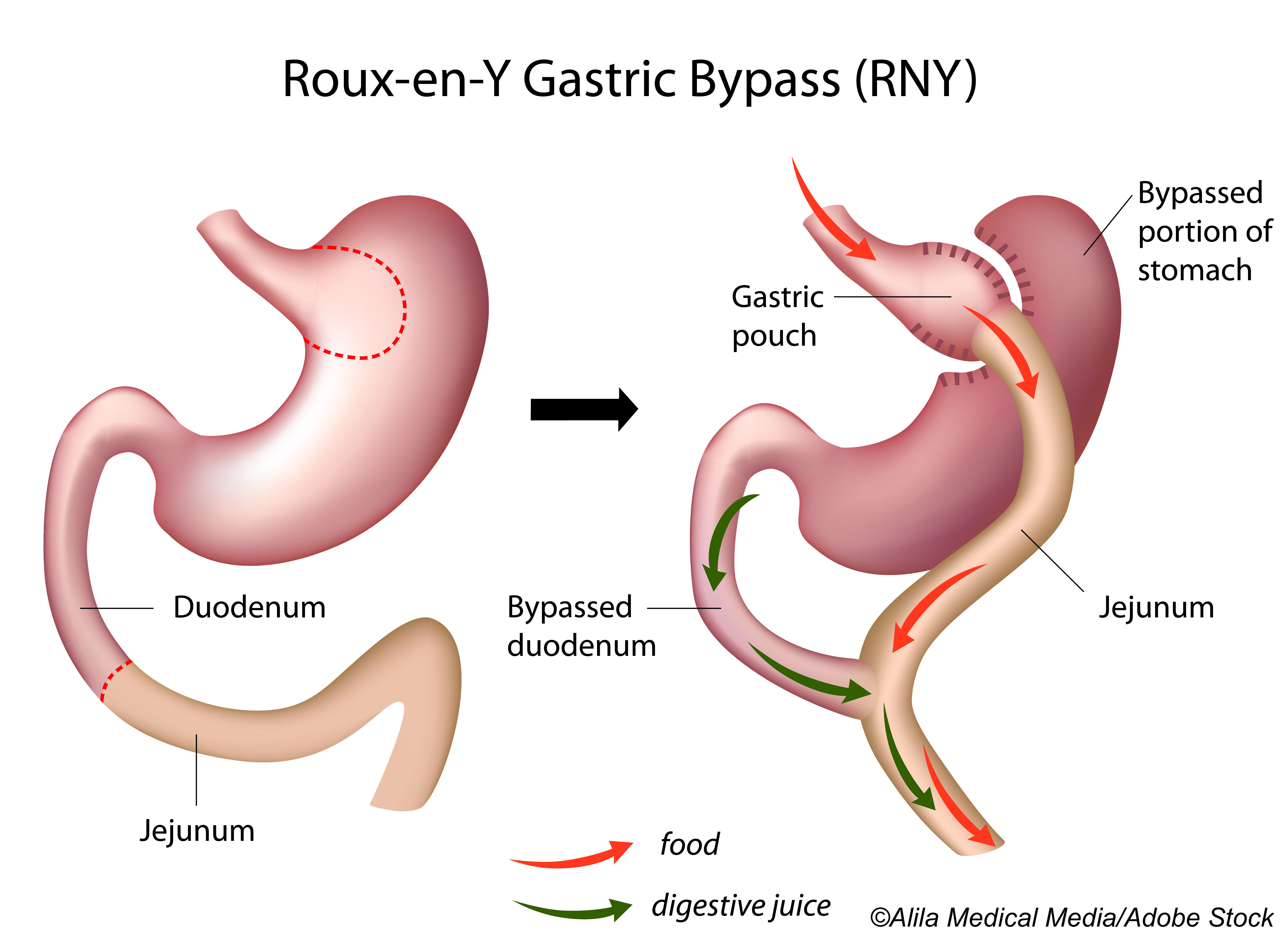 Sleeve Gastrectomy, Roux-en-Y Both Improve Hepatic Steatosis in Type 2 Diabetes