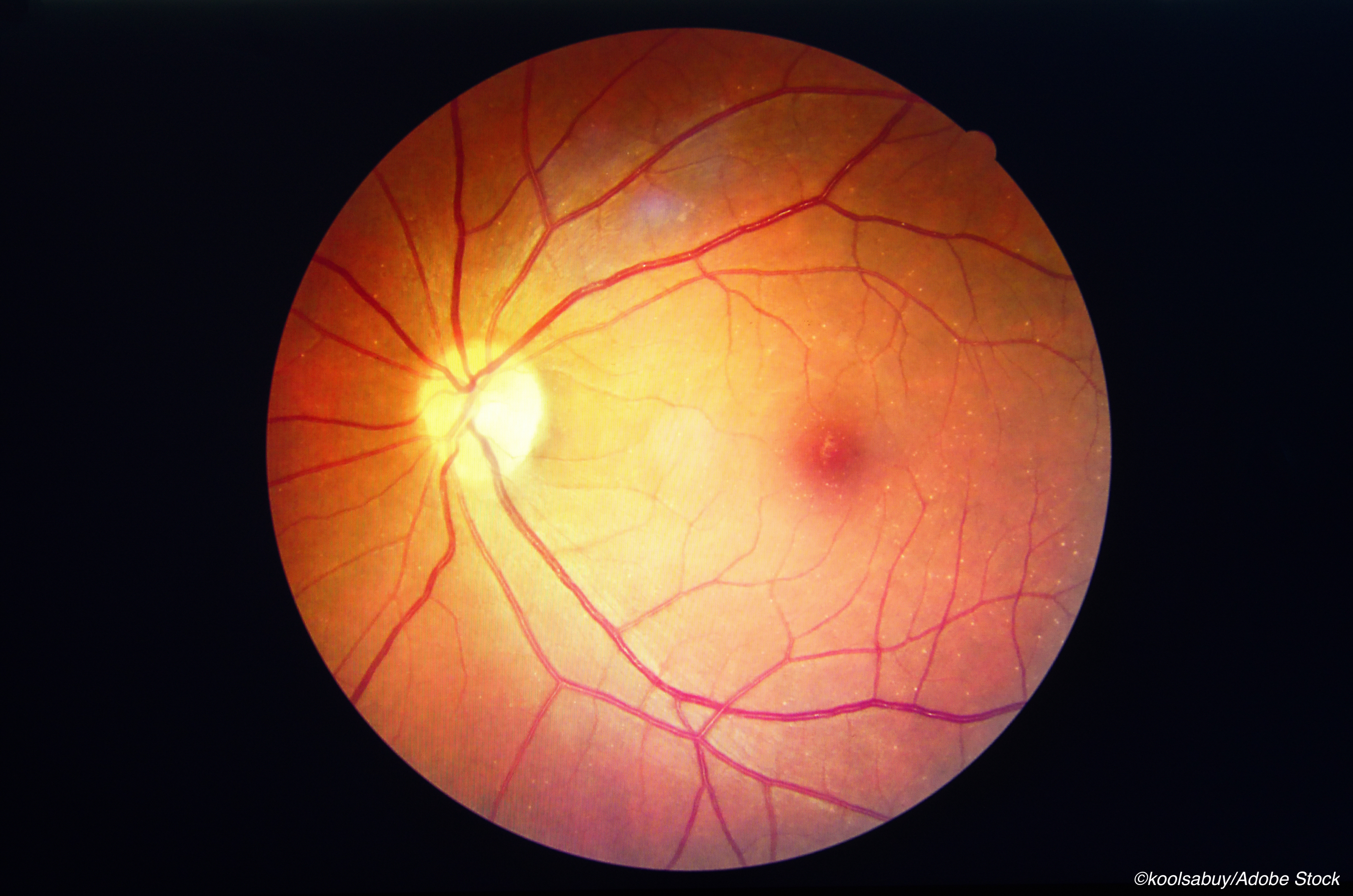 Kids with T2D Developed Retinopathy Faster, More Often Than Kids with T1D