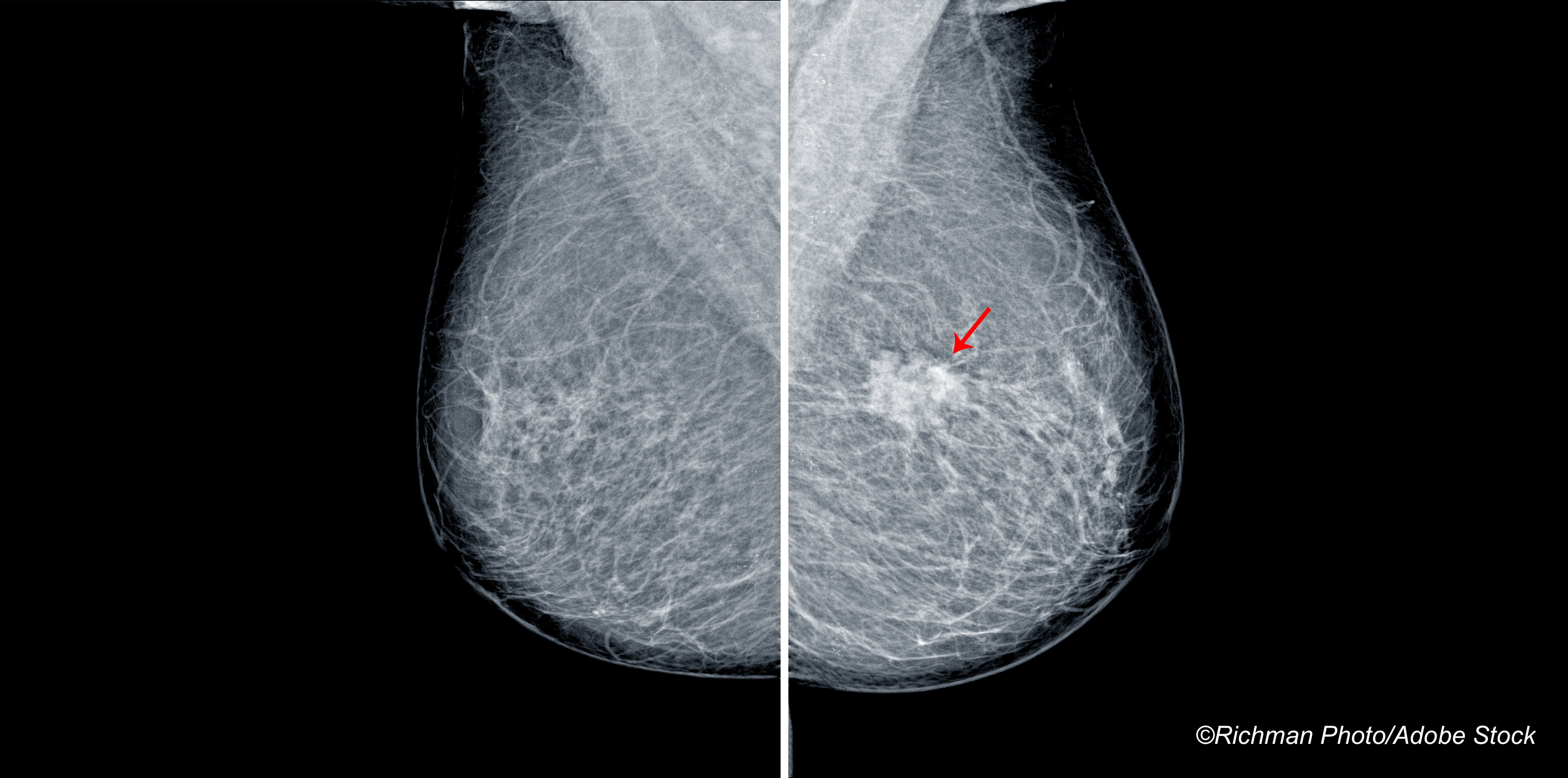 RSNA: Real World Test of AI Gets Good Marks