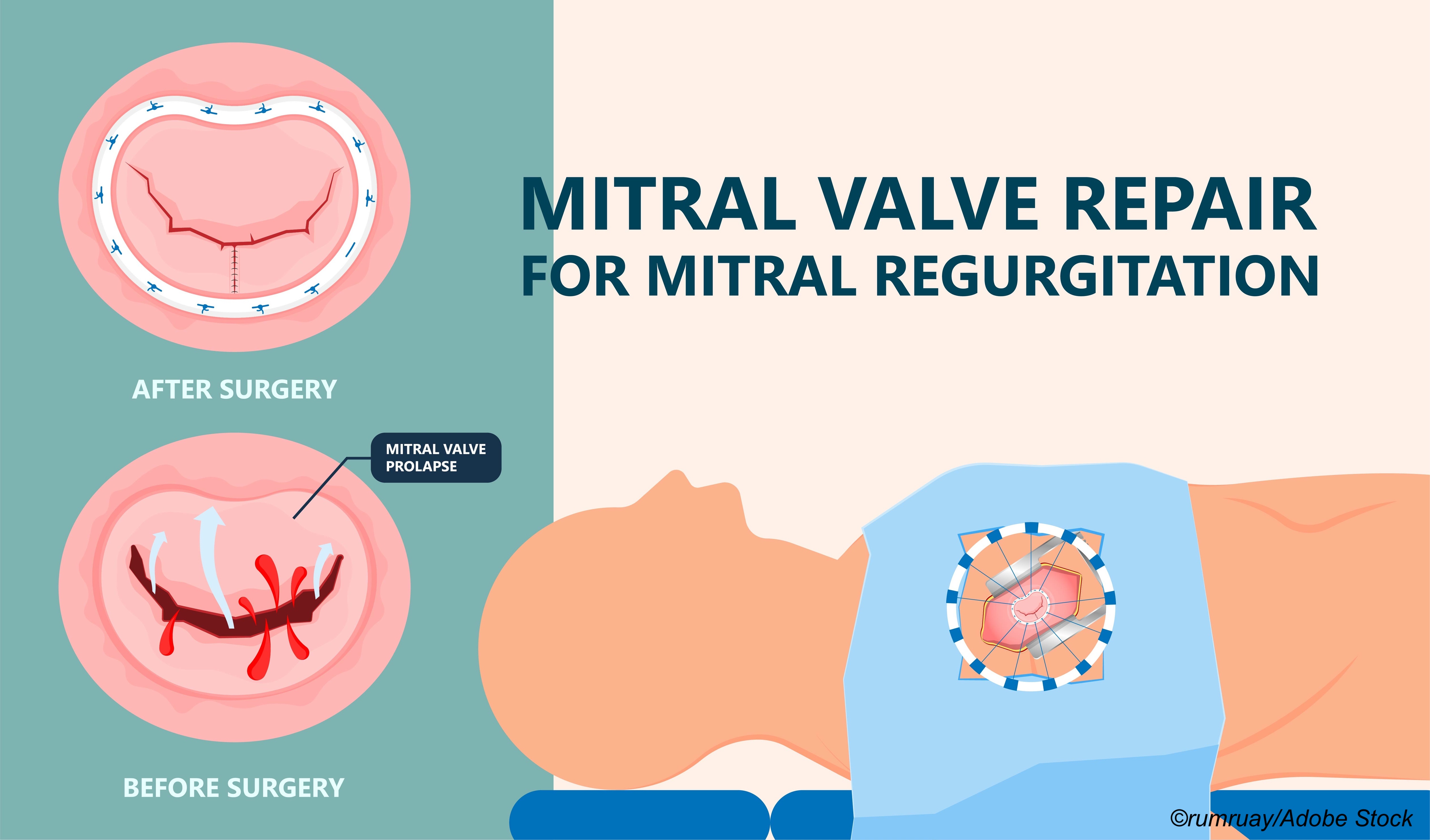 Secondary Mitral Regurgitation: COAPT Inclusion Criteria Helpful in M-TEER Patient Selection