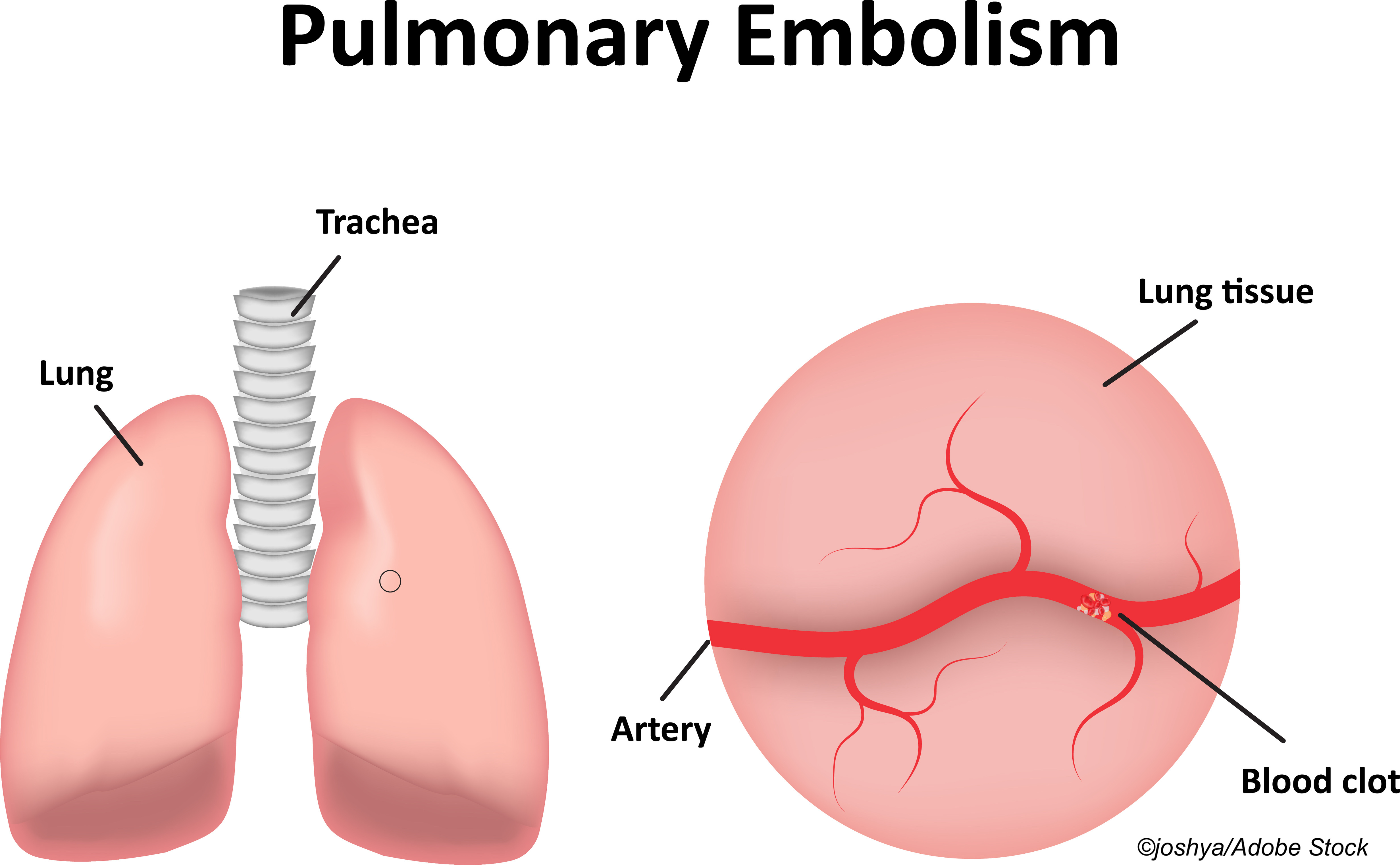 YEARS Rule + D-Dimer as Good as Conventional Dx to Rule Out Pulmonary Embolism
