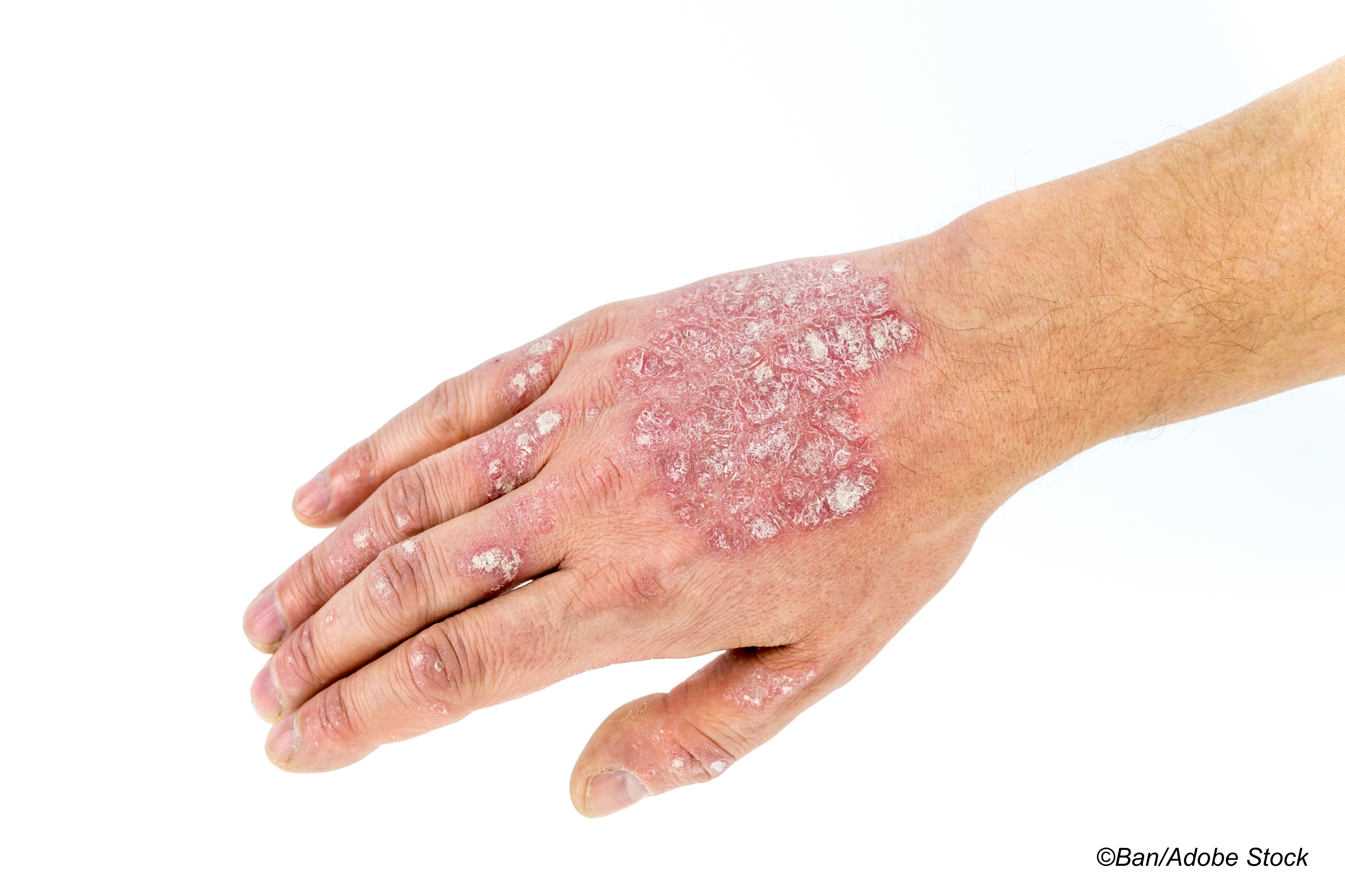 First-in-Class Tapinarof Effective in Mild-to-Moderate Plaque Psoriasis