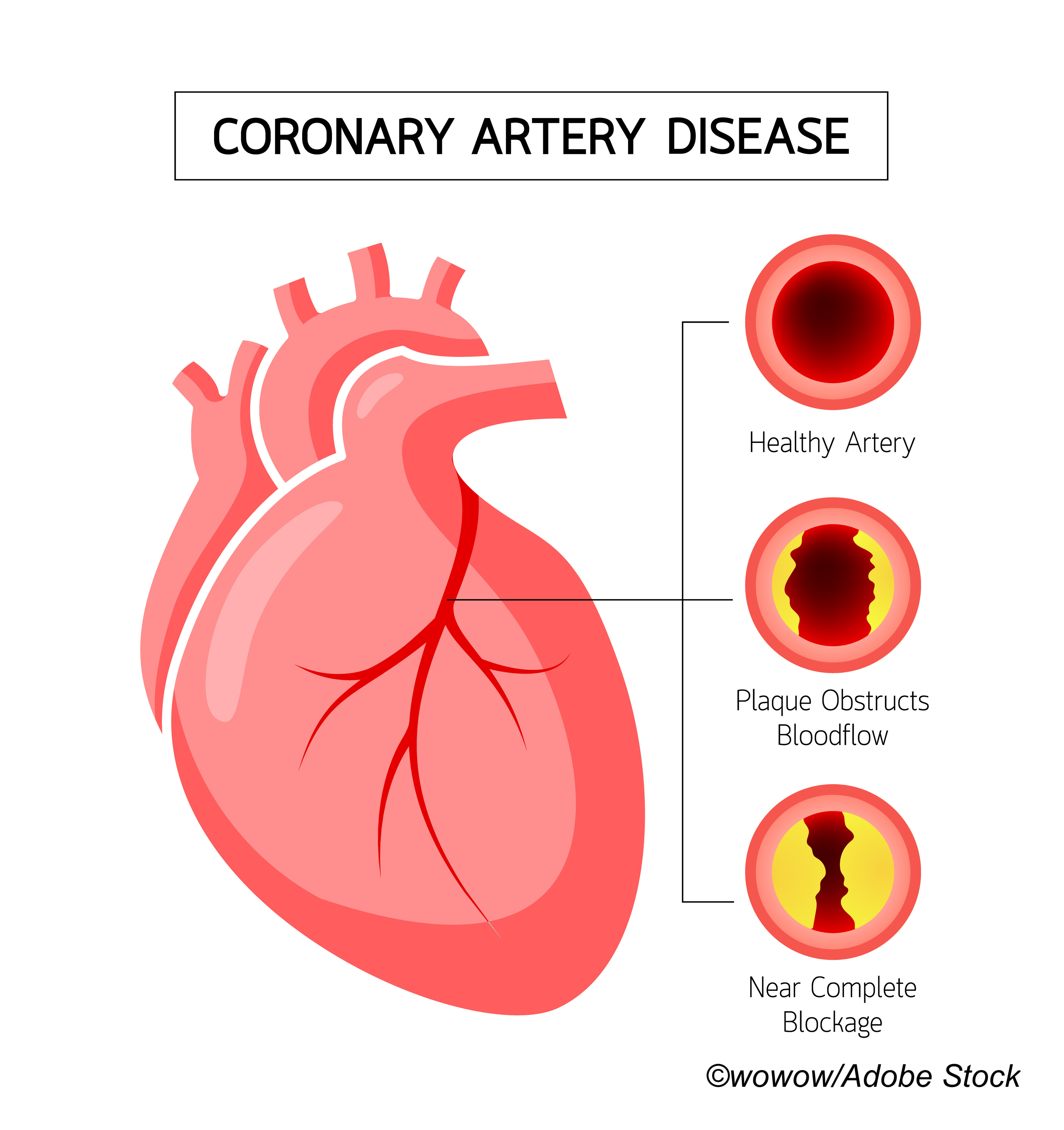 ACC/AHA Issues New Coronary Artery Revascularization Guideline
