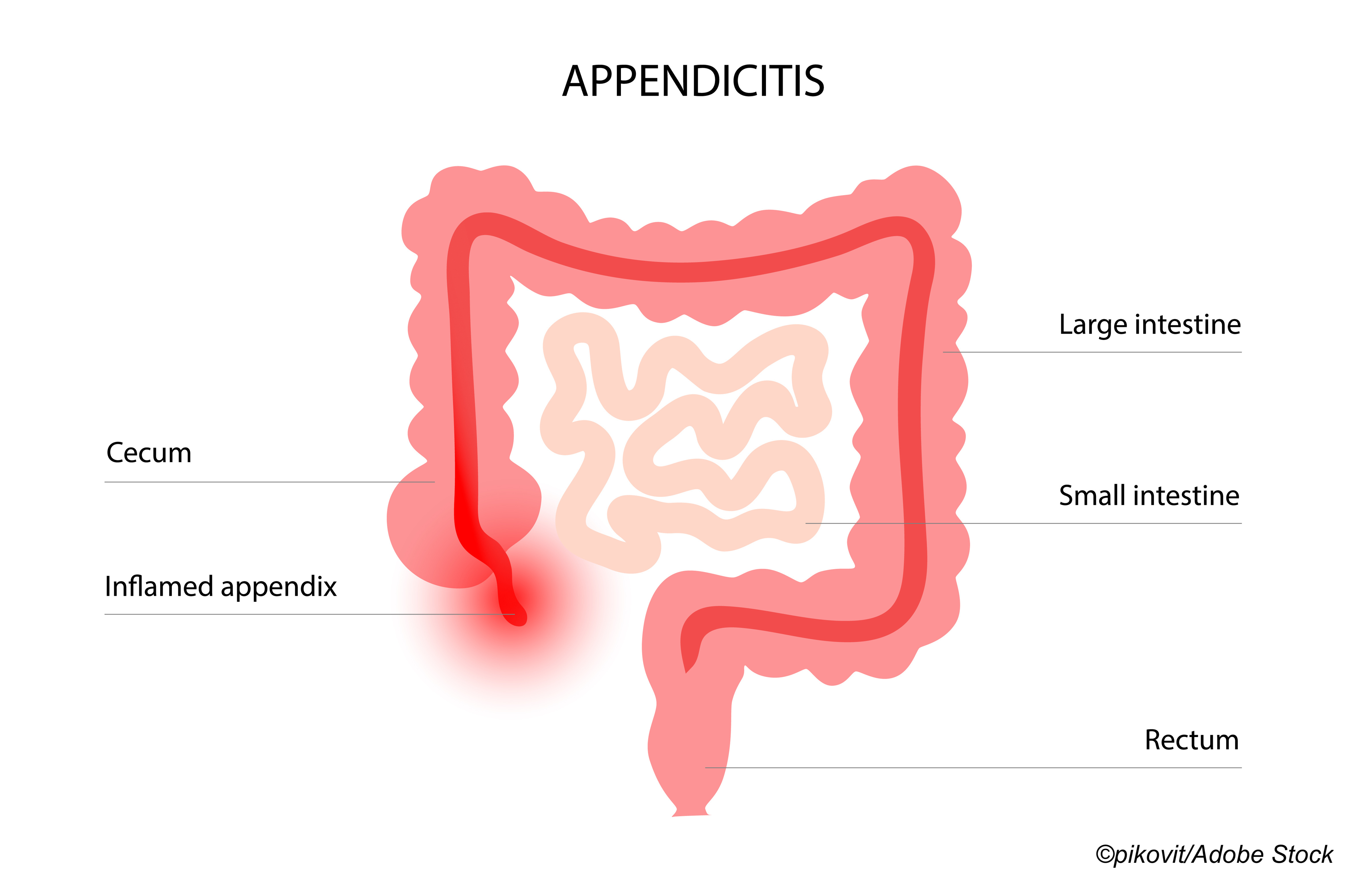 Acute Appendicitis: Looking at Treatment Options Beyond Surgery