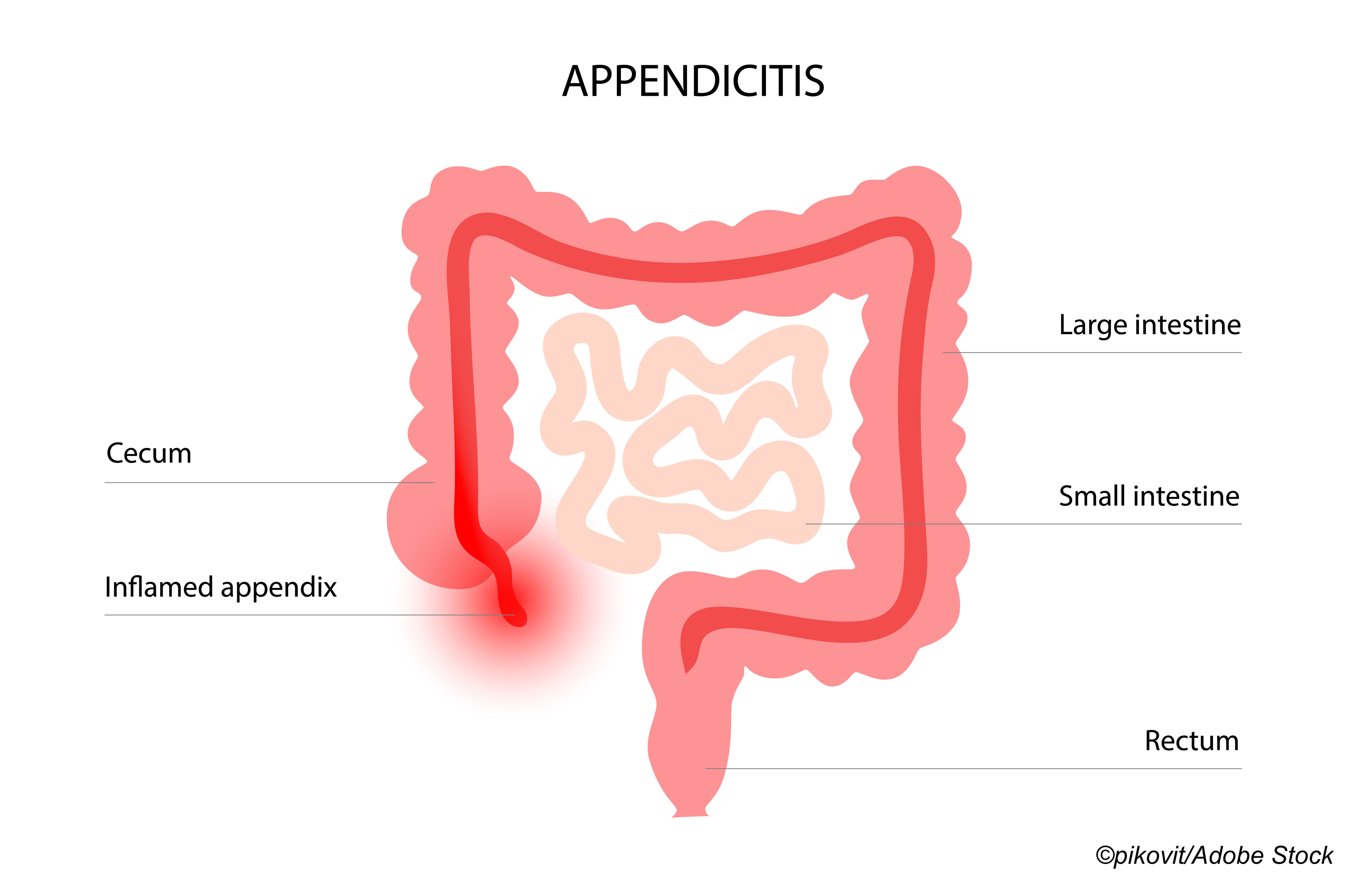 Is Appendicitis Acute