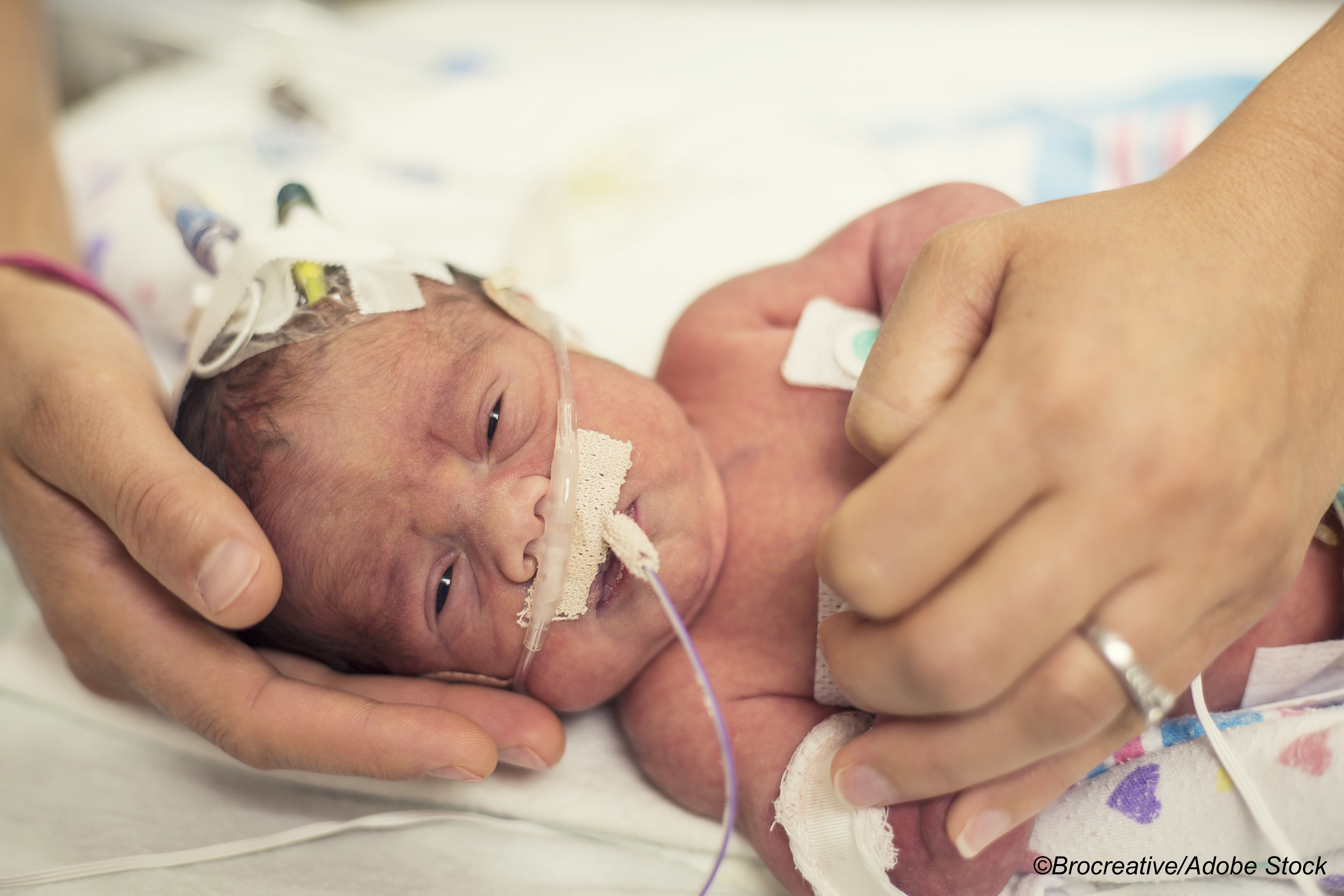 Neonatal Seizures: Little Difference Between EEG/Clinical Treatment