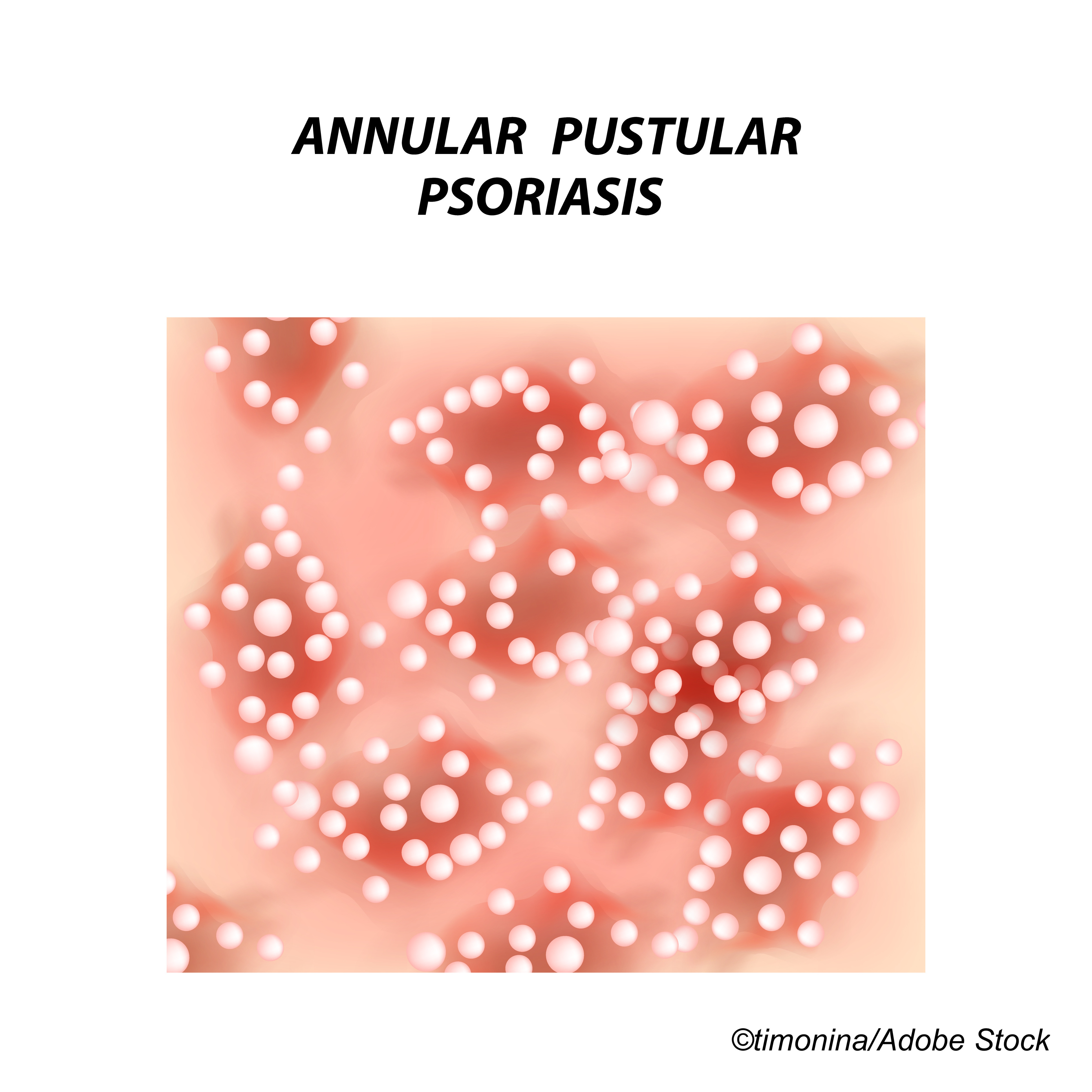Investigational Spesolimab Proves Mettle In Generalized Pustular Psoriasis Physician S Weekly