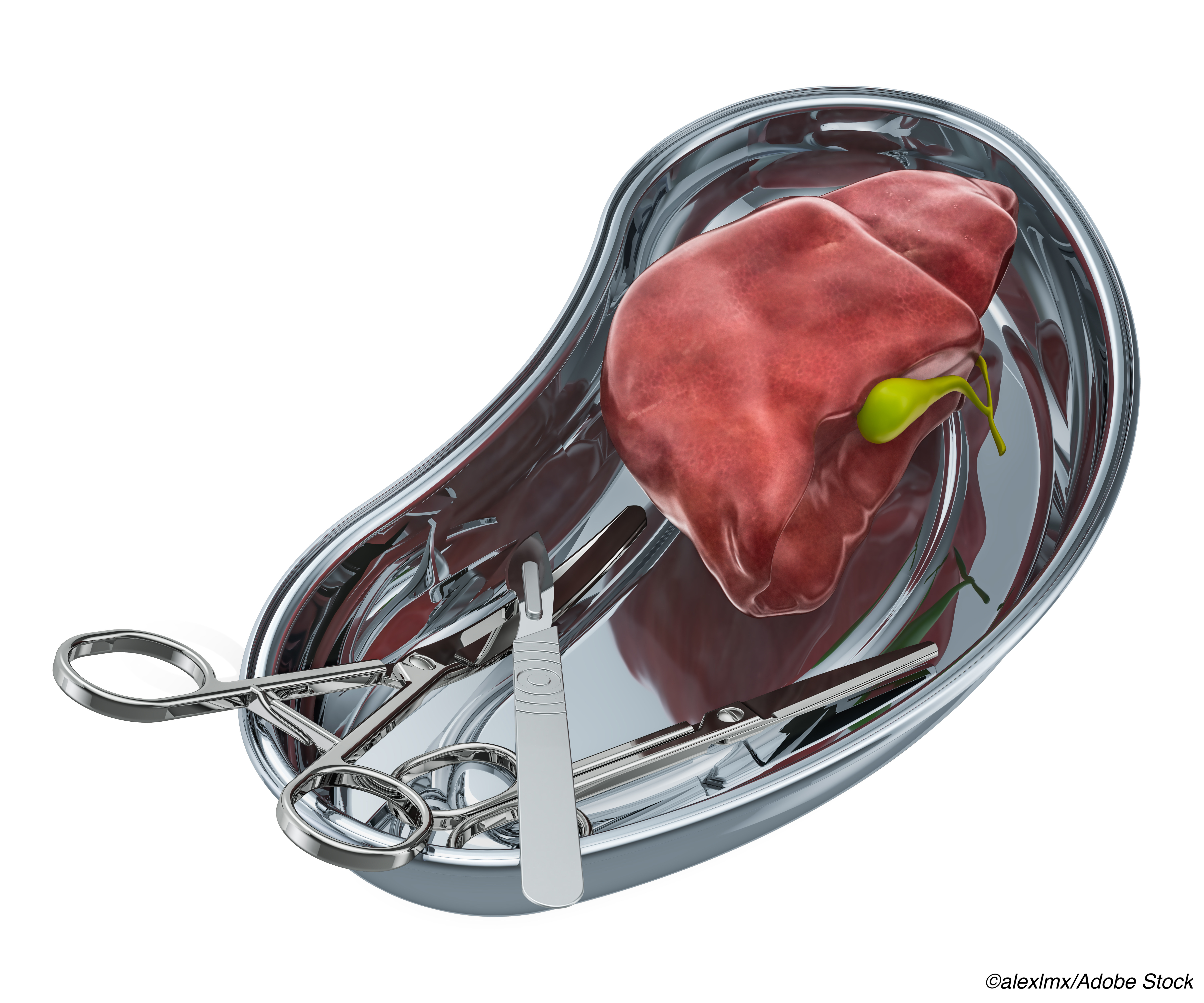 Normothermic Machine Perfusion Improves Outcomes in Liver Transplant Recipients