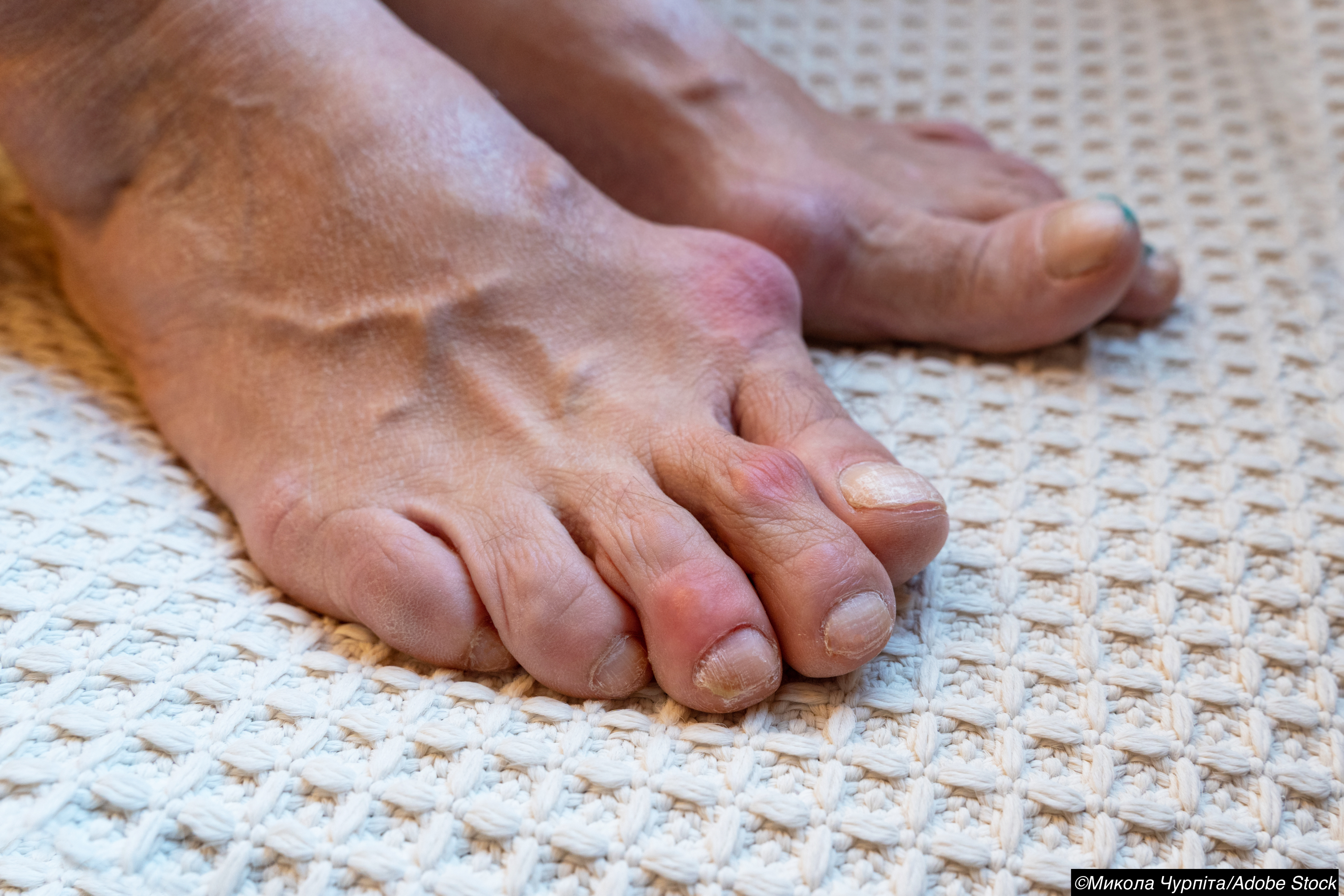 VA Study: Gout Ups Risk for Lower Extremity Amputation by 20%