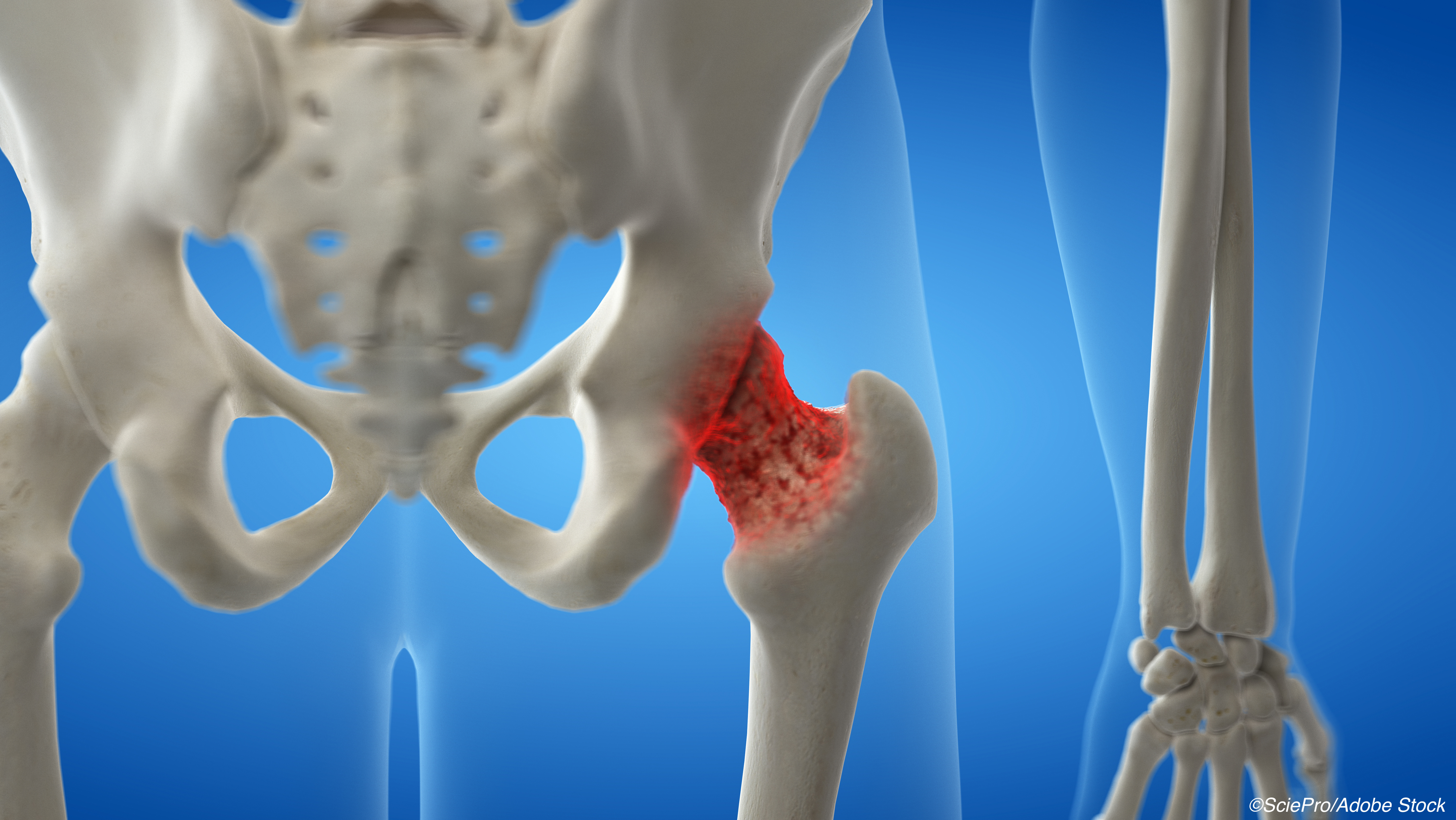 Bone Drug Holidays: Worth the Small But Higher Fracture Risk?
