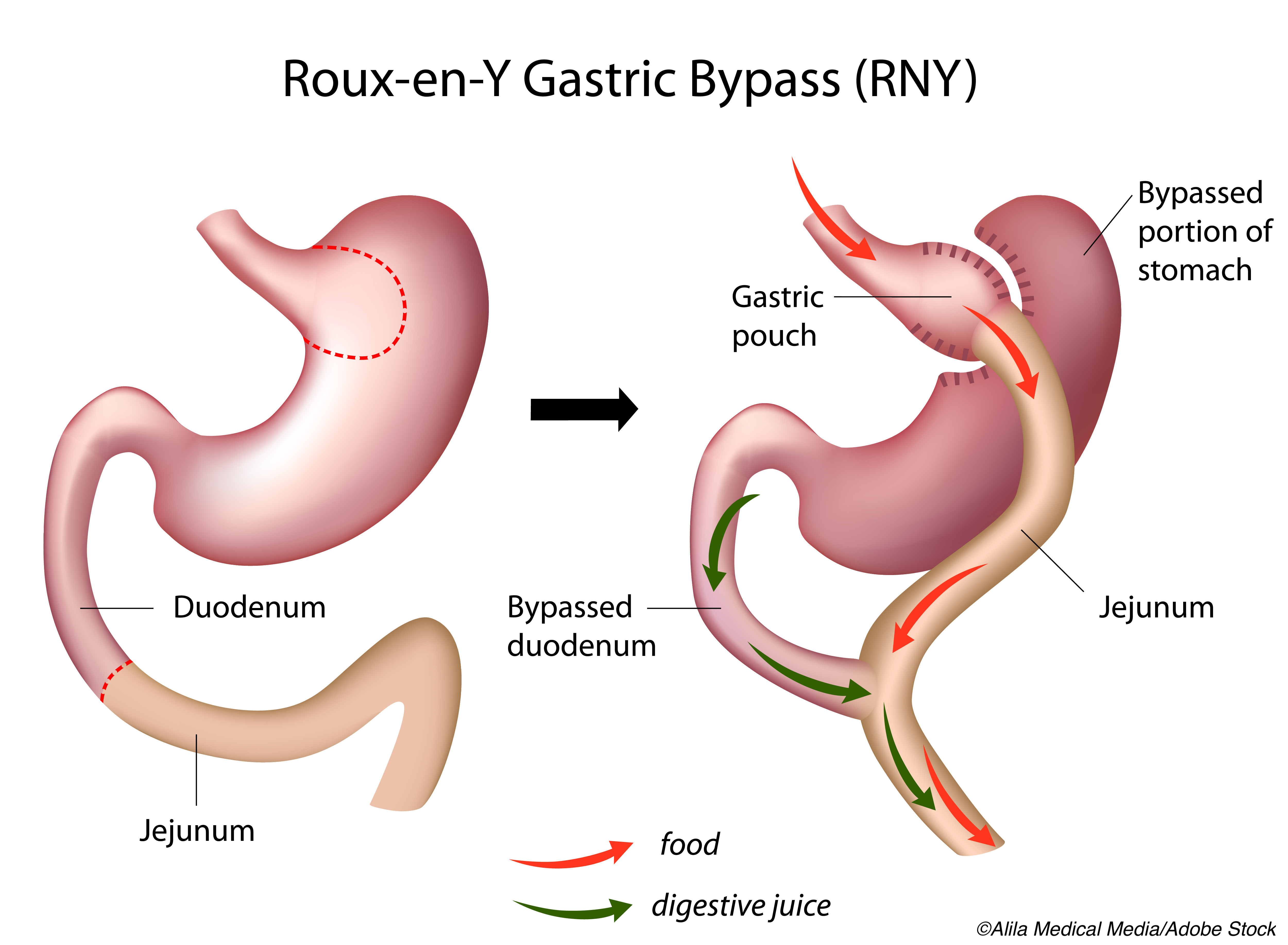 Bariatric Surgery: Analysis Suggests Gastric Bypass May Be Better Option