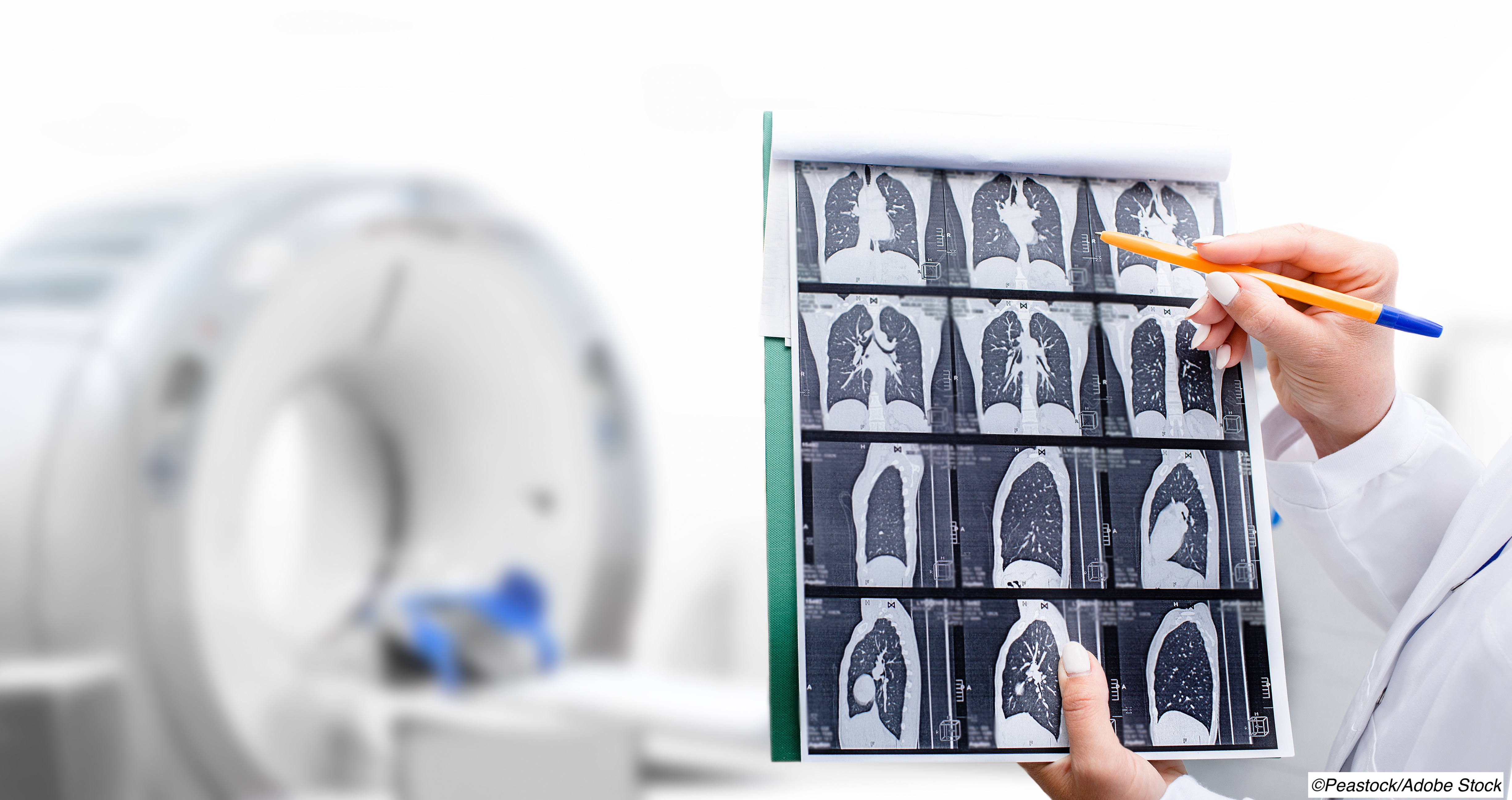 Broader USPSTF Guidelines for Lung Ca Screening Help Reduce Racial Disparity