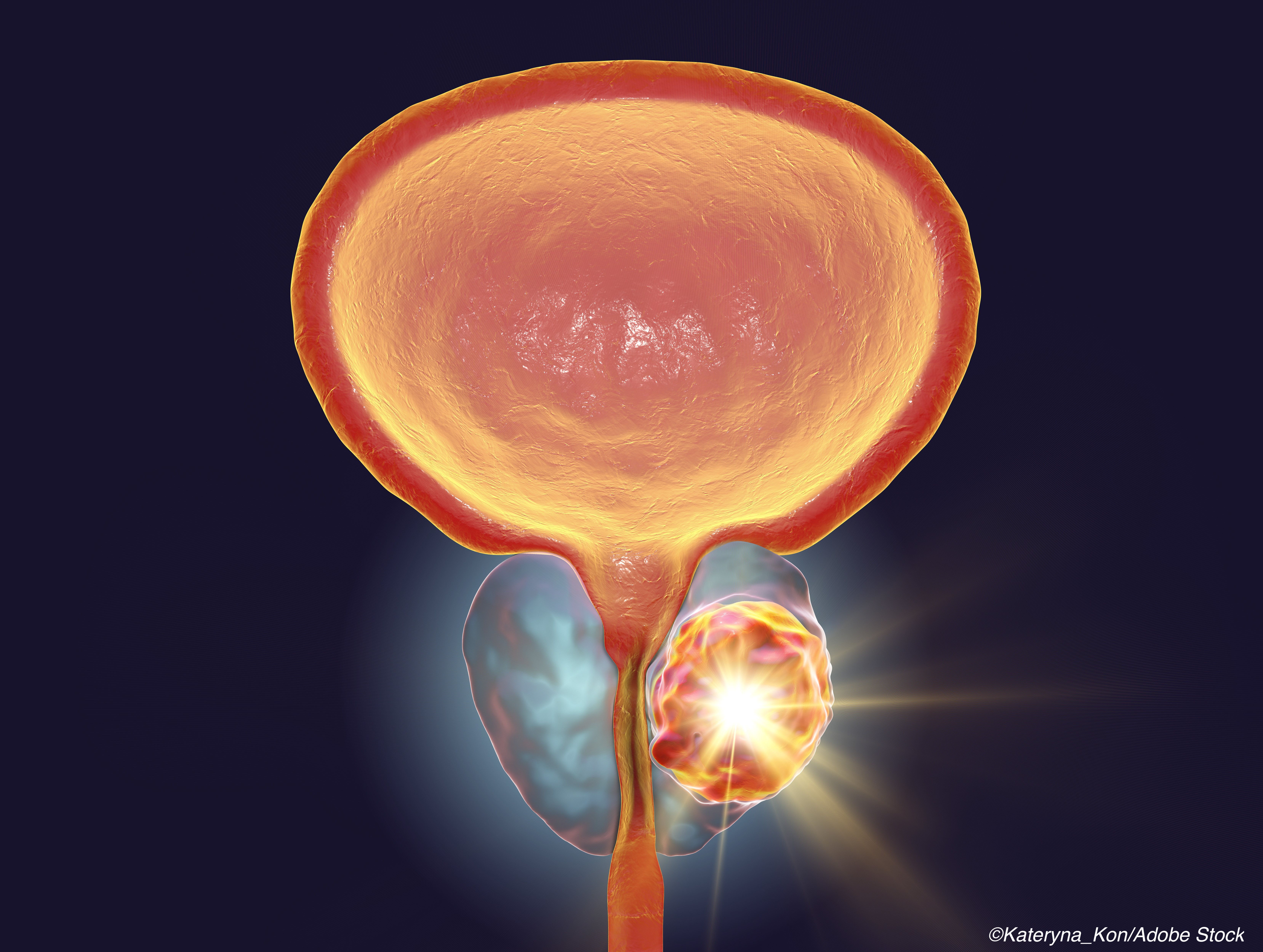 Prostate Ca: PSA Confirms Benefit of Apalutamide; PARP-AAP Combo Promising