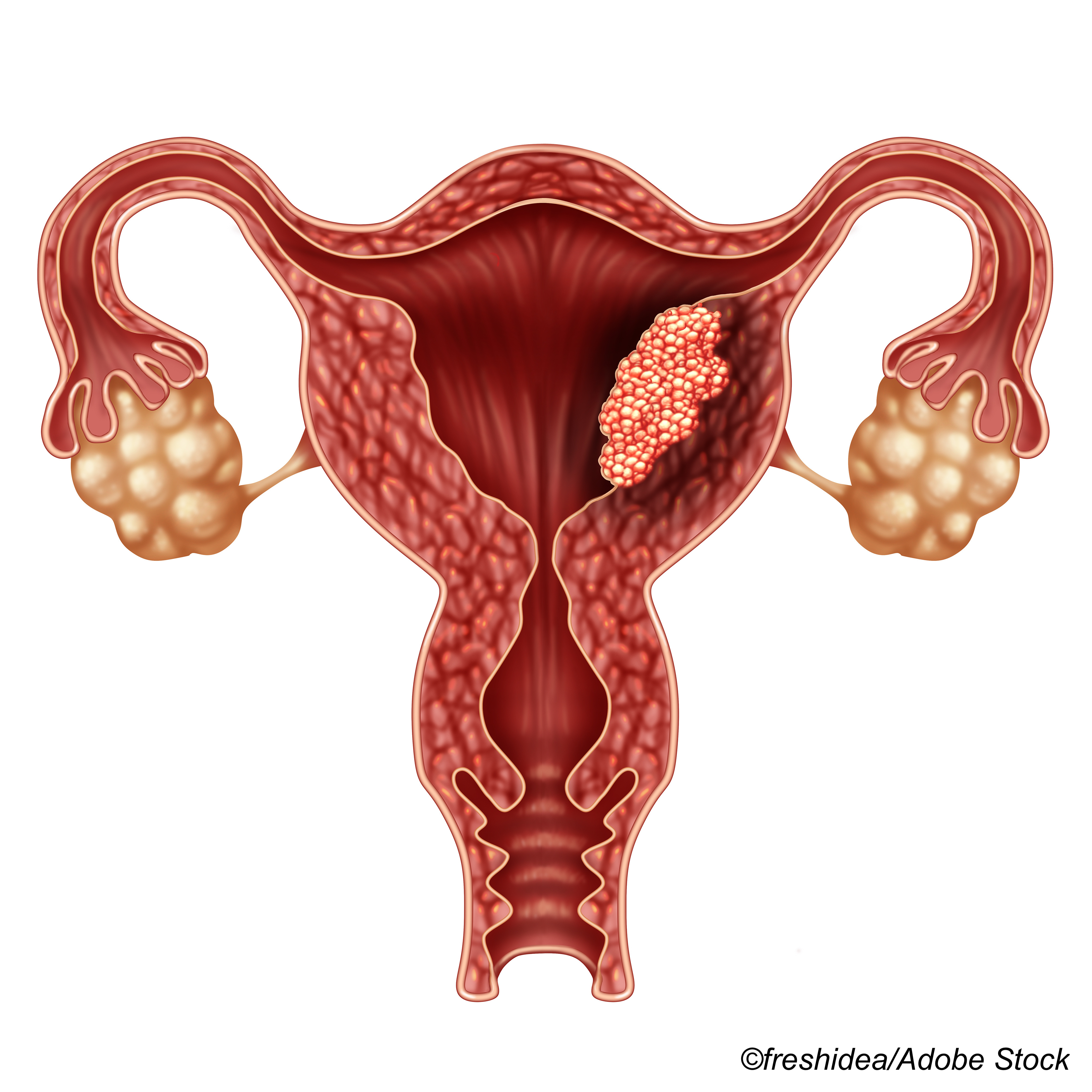 Two-Agent Regimen Proves Mettle in Advanced Endometrial Cancer
