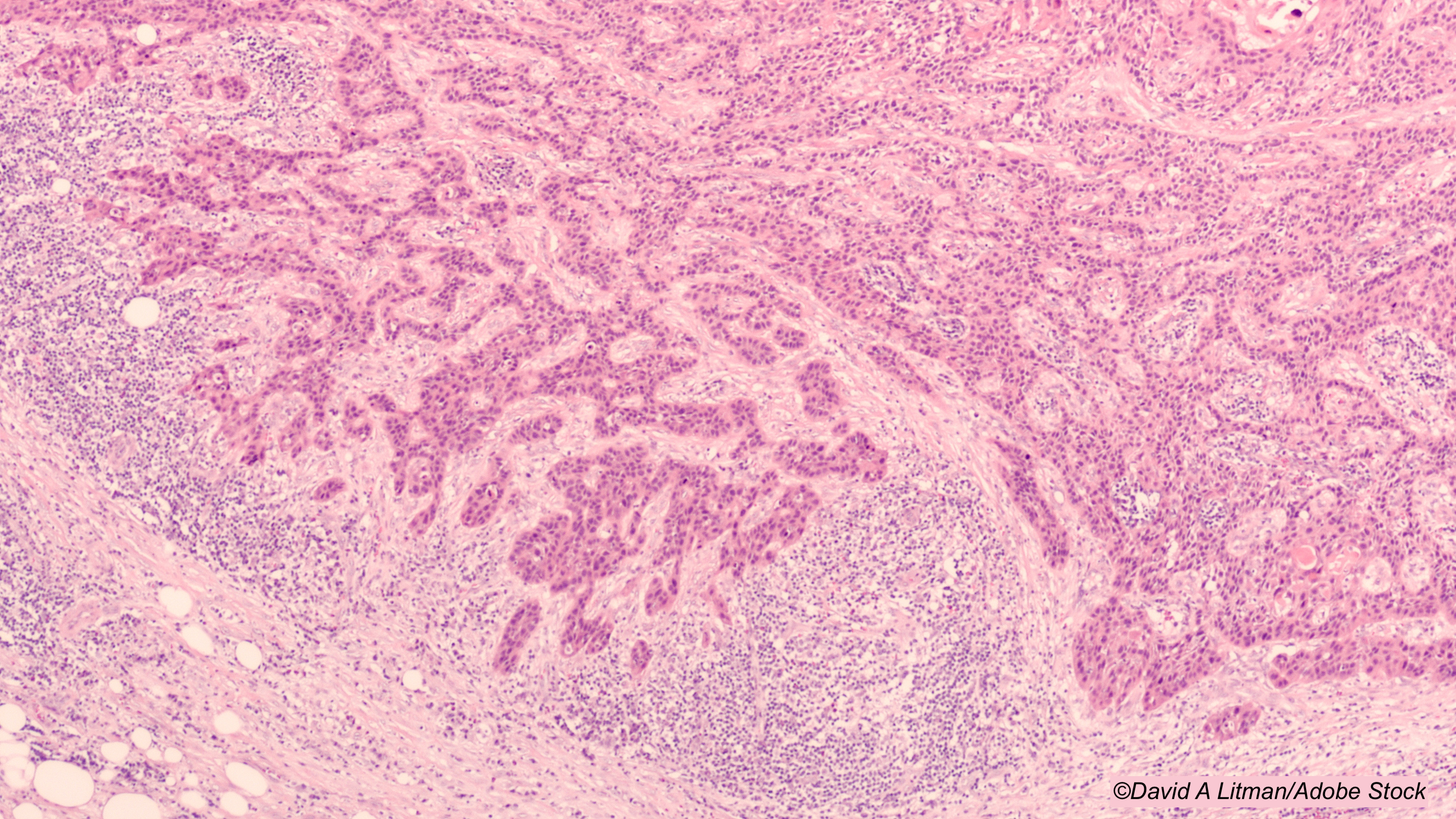 Study Finds Lower Dose Radiotherapy Effective in HPV+  Oropharyngeal Carcinoma