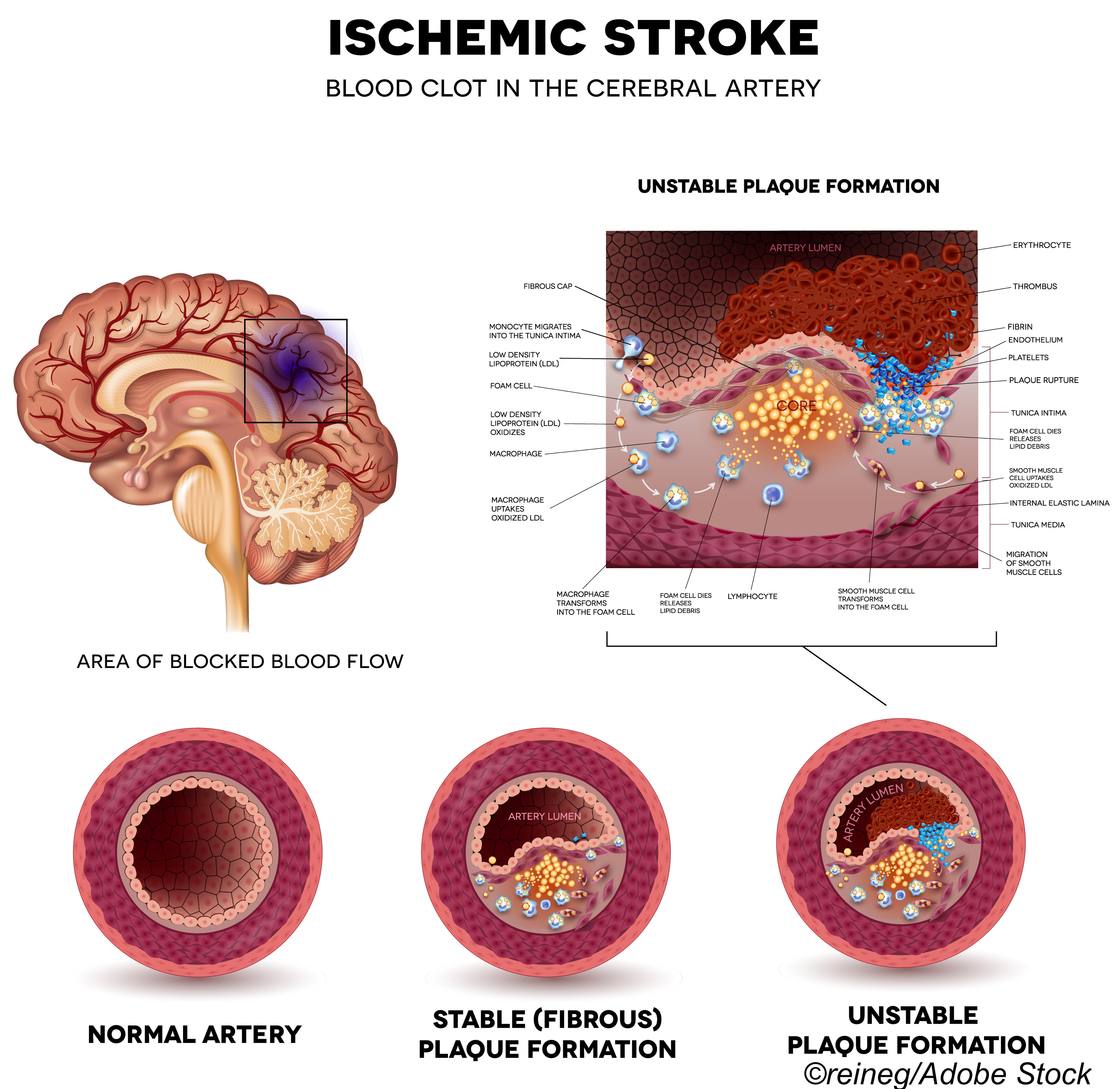 Stroke Recurrence, Severity Ups Dementia Risk