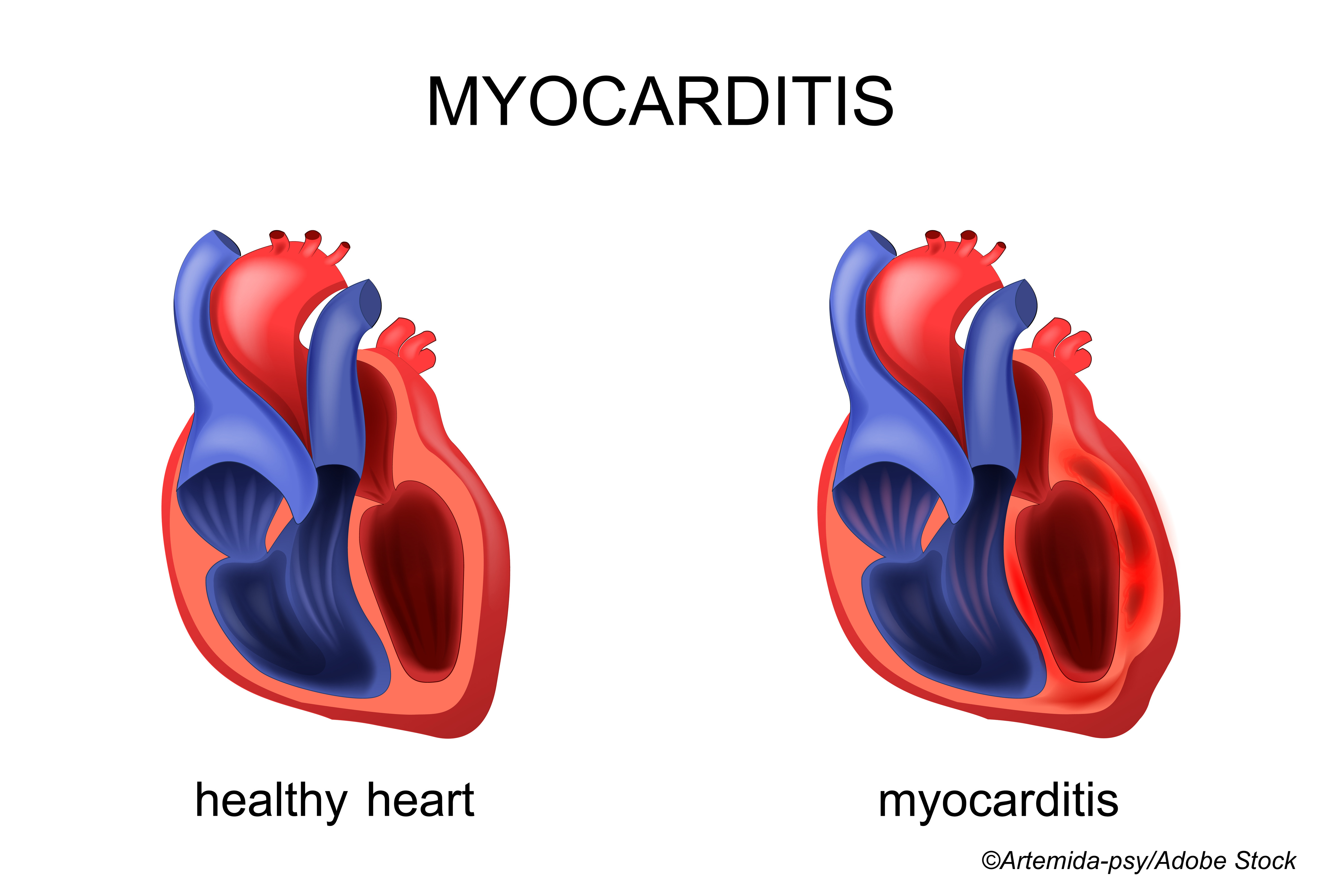 VAERS Data Confirm Myocarditis Risk After mRNA Vaccine