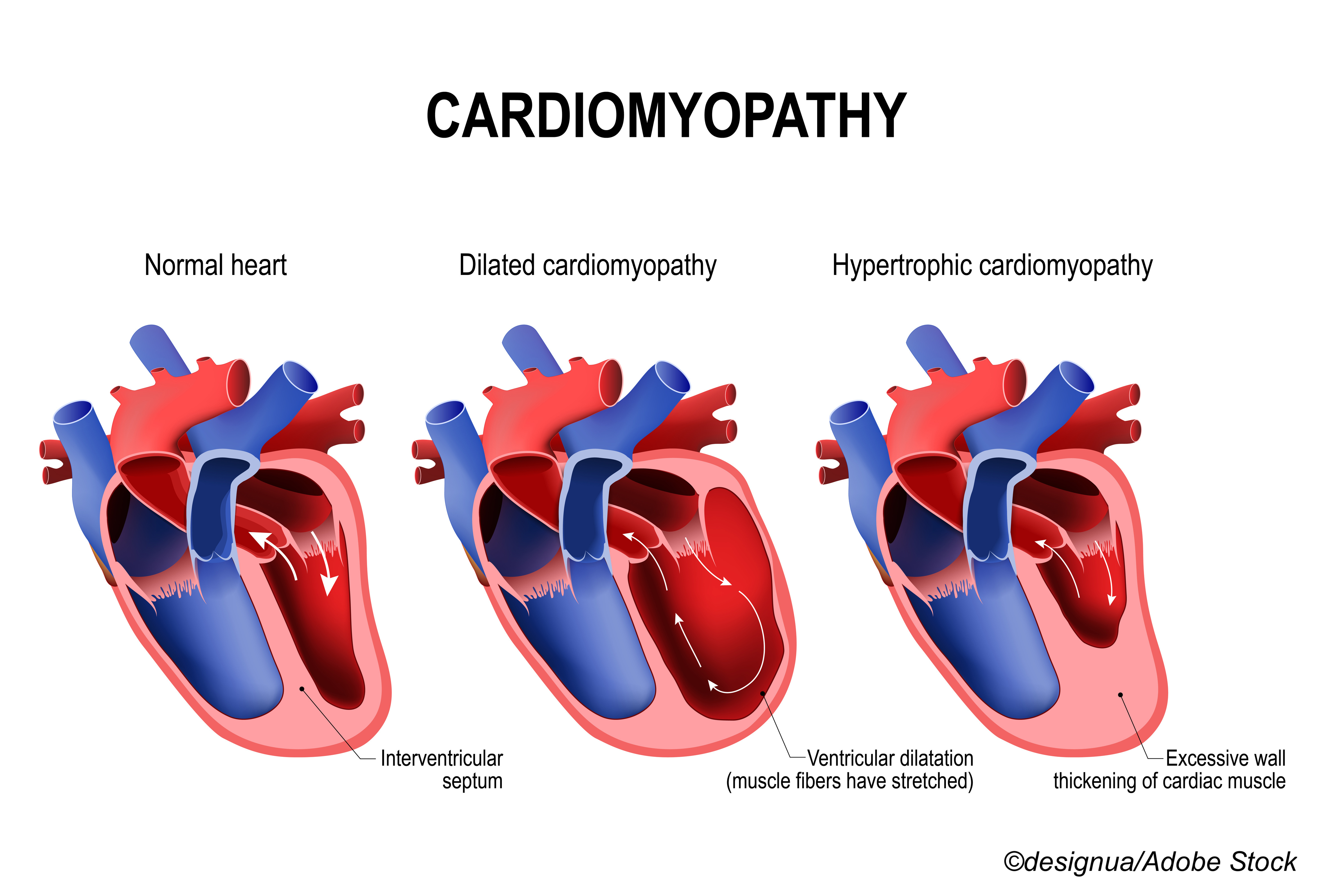 Novel Dilated Cardiomyopathy Subtypes Differentiate Prognosis