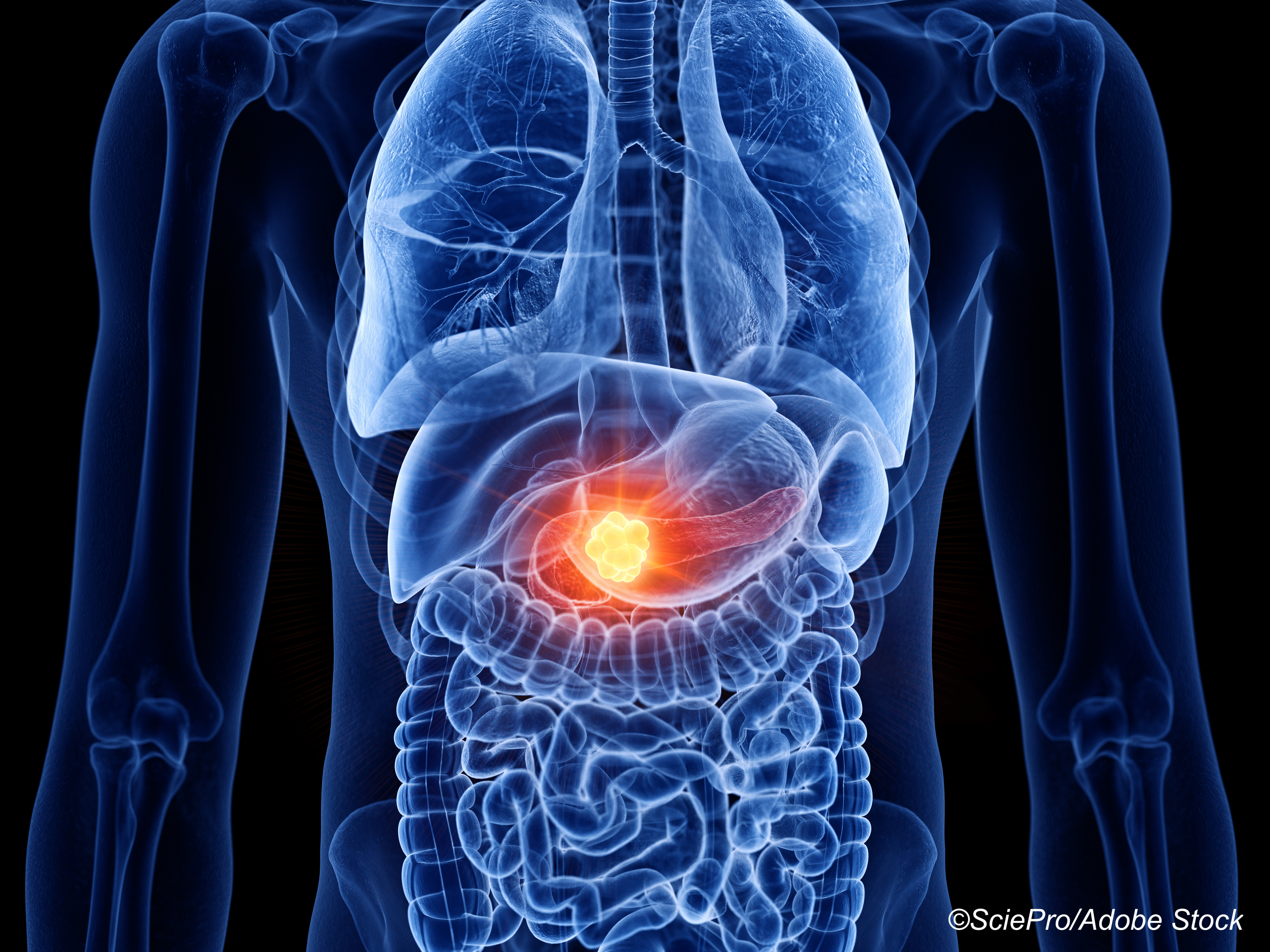New Kind of T-Cell Therapy Promising Against Pancreatic Cancer