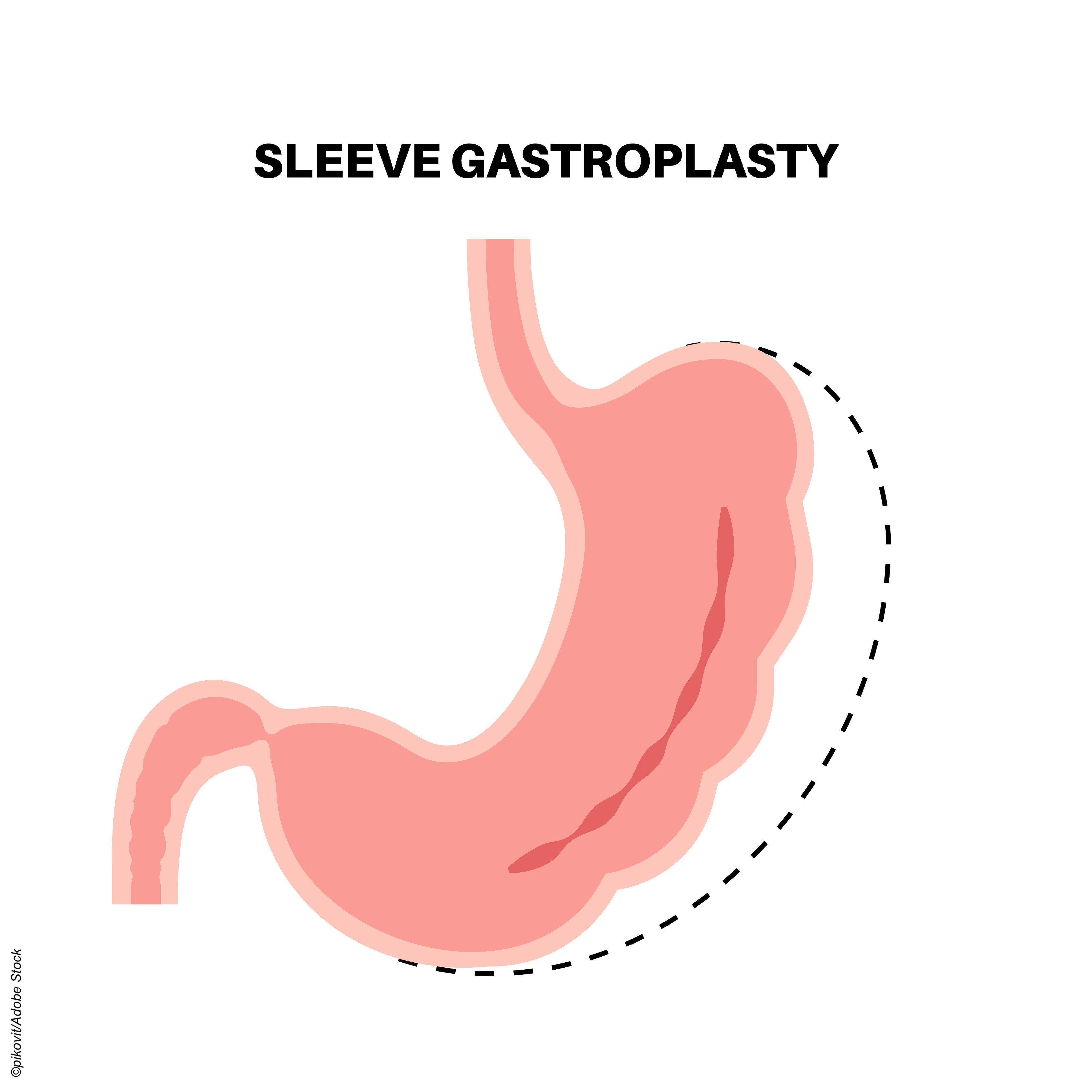 semaglutide contraindications pancreatitis A Review of the Oral Semaglutide in Adults with Overweight or Obesity (OASIS) Trials Evaluating Oral Semaglutide (Wegovy) for Chronic Weight Management in Adults With Overweight or Obesity semaglutide contraindications pancreatitis A Review of the Oral Semaglutide in Adults with Overweight or Obesity (OASIS) Trials Evaluating Oral Semaglutide (Wegovy) for Chronic Weight Management in Adults With Overweight or Obesity