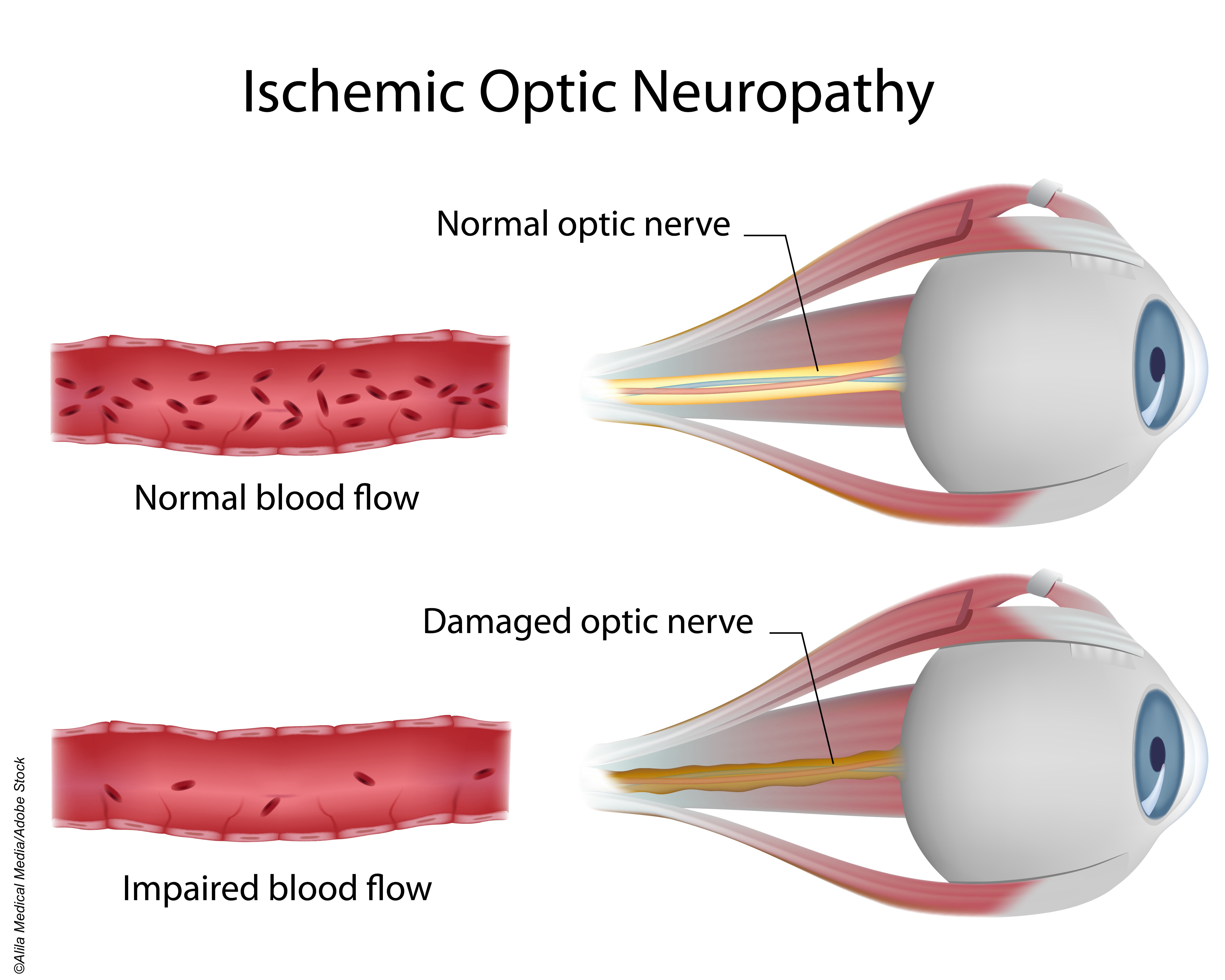 blindness from semaglutide Breaking Med